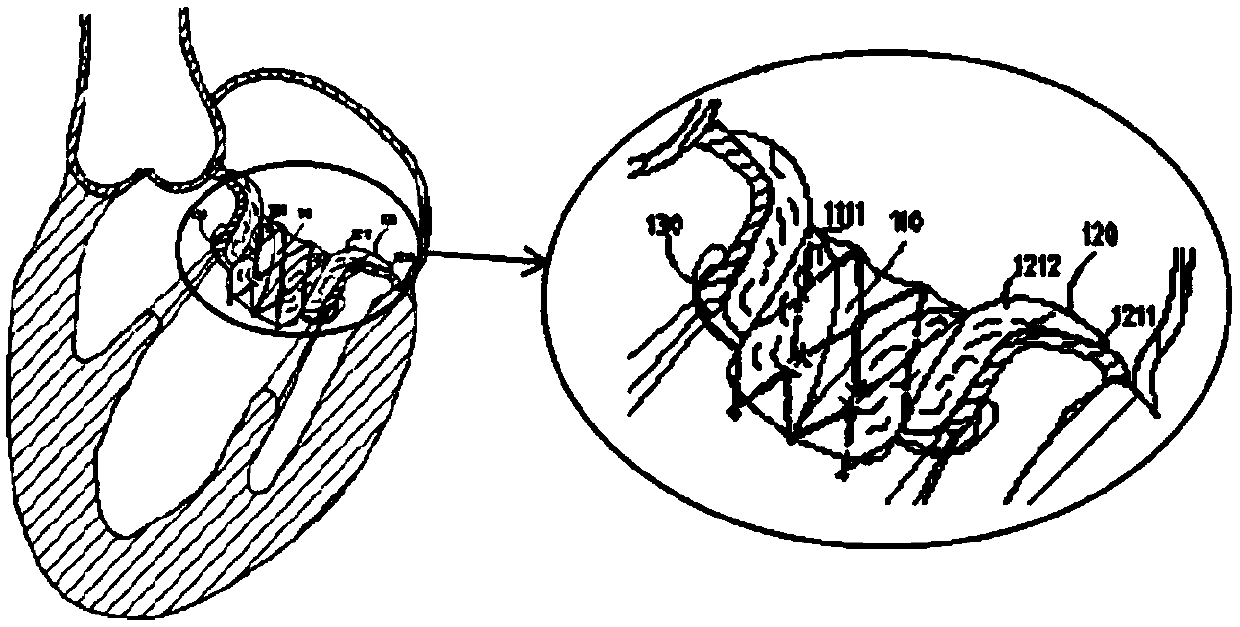 Artificial heart valve prosthesis and artificial heart valve stent