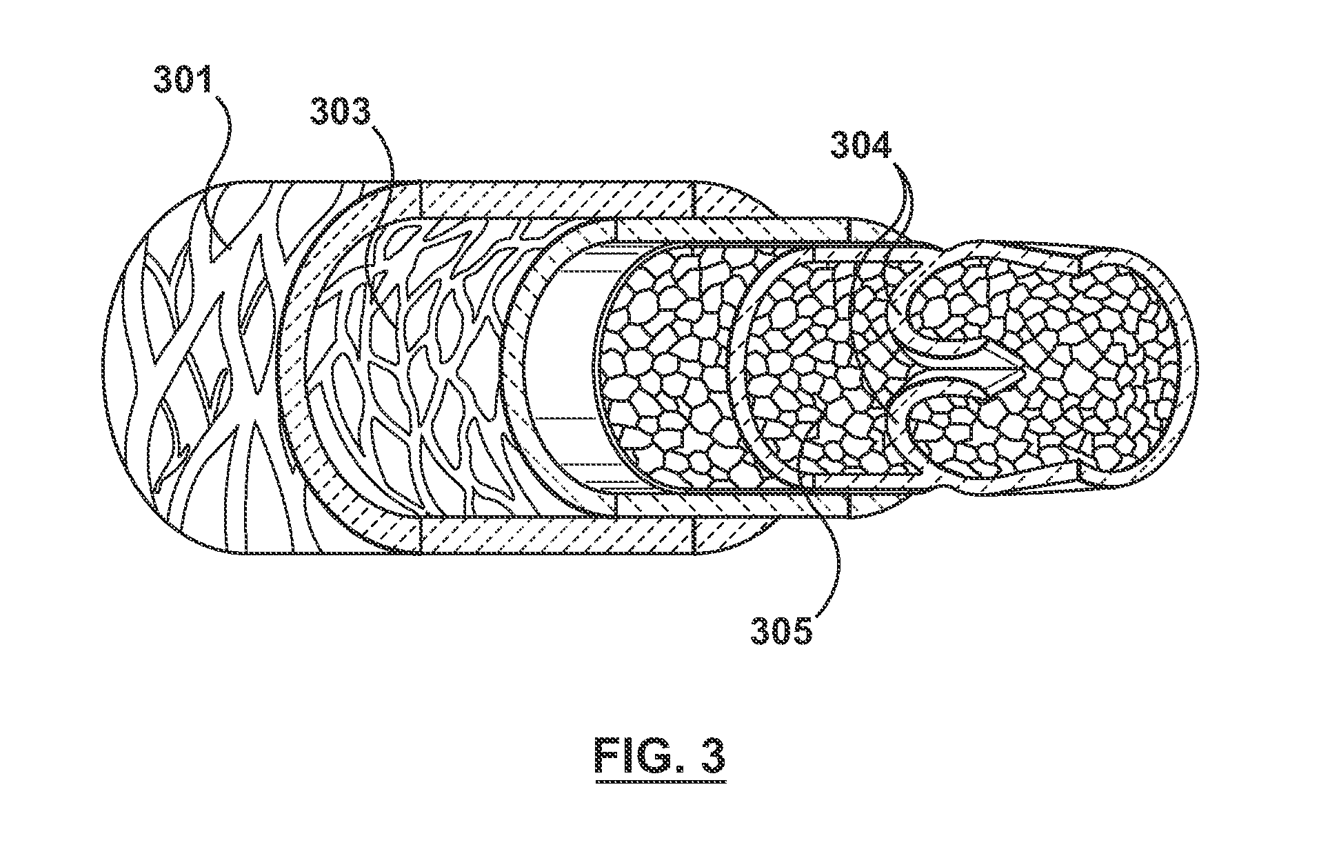 Percutaneous Methods and Apparatus for Creating Native Tissue Venous Valves