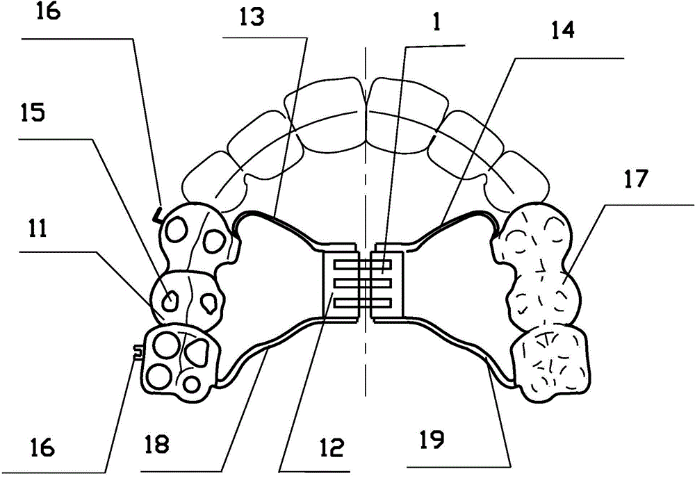 Device for relieving buccal crossbite for fixed type asymmetric occlusal pad combined casting crown