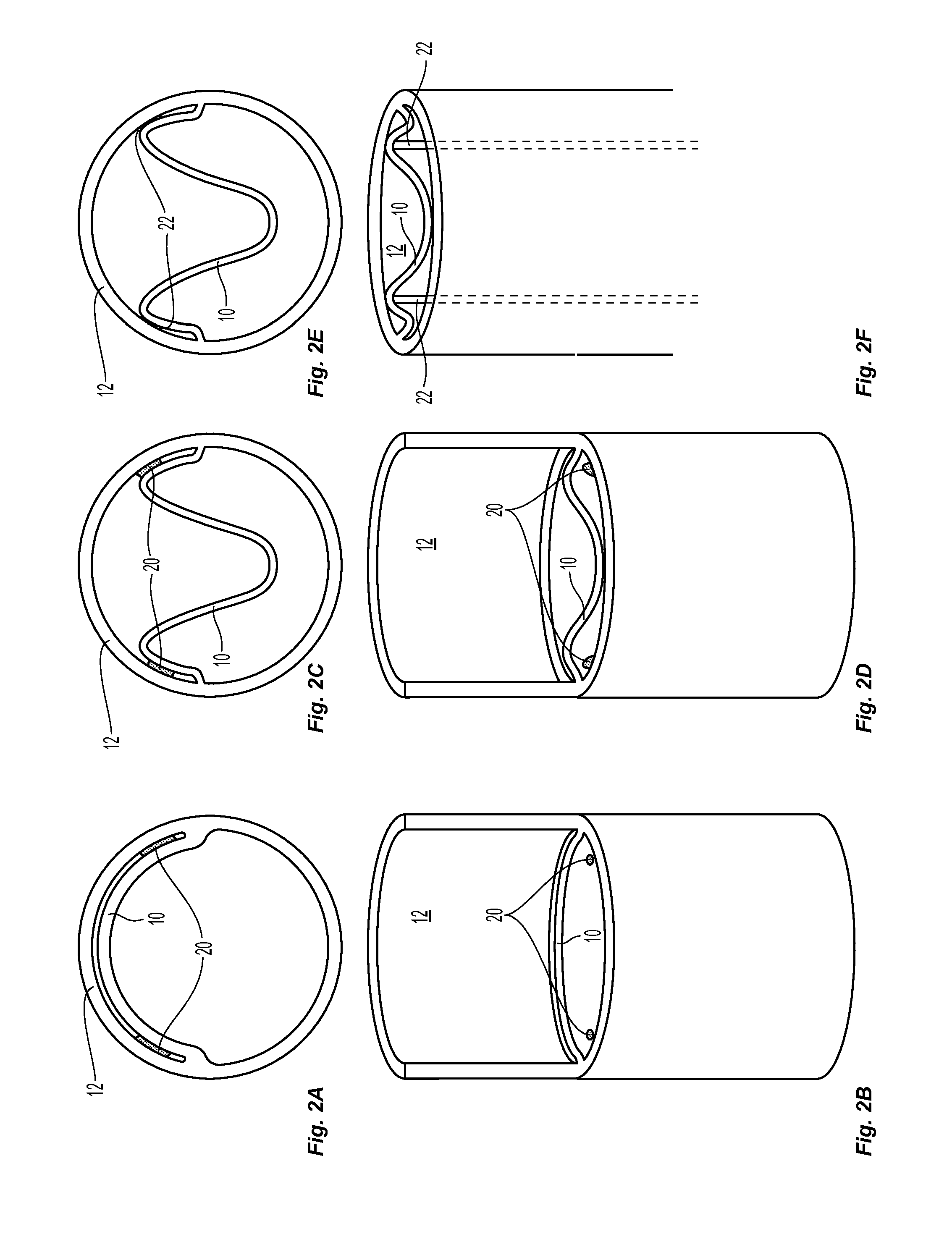 Systems and methods for endoluminal valve creation