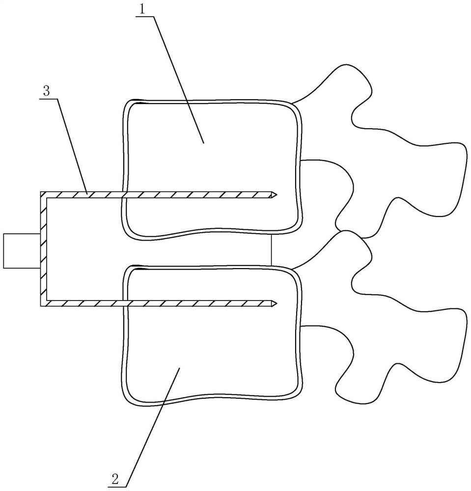 Replacement-free intervertebral disc prosthesis based on intelligent medical treatment