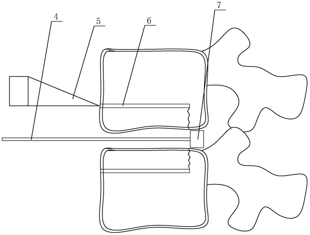 Replacement-free intervertebral disc prosthesis based on intelligent medical treatment