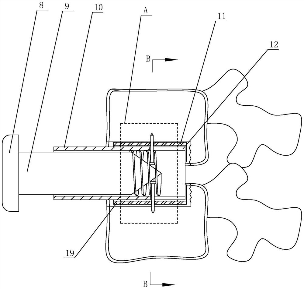 Replacement-free intervertebral disc prosthesis based on intelligent medical treatment