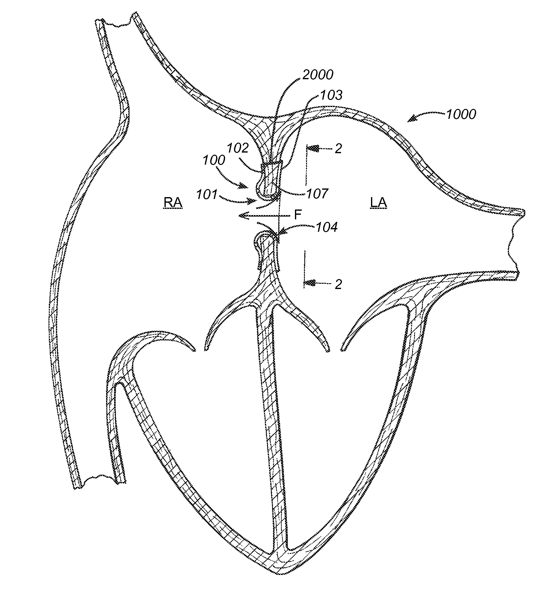 Devices, systems and methods to treat heart failure