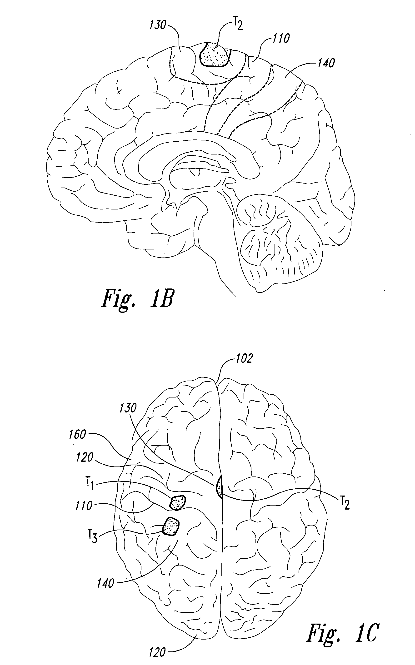 Electrode configurations for reducing invasiveness and/or enhancing neural stimulation efficacy, and associated methods