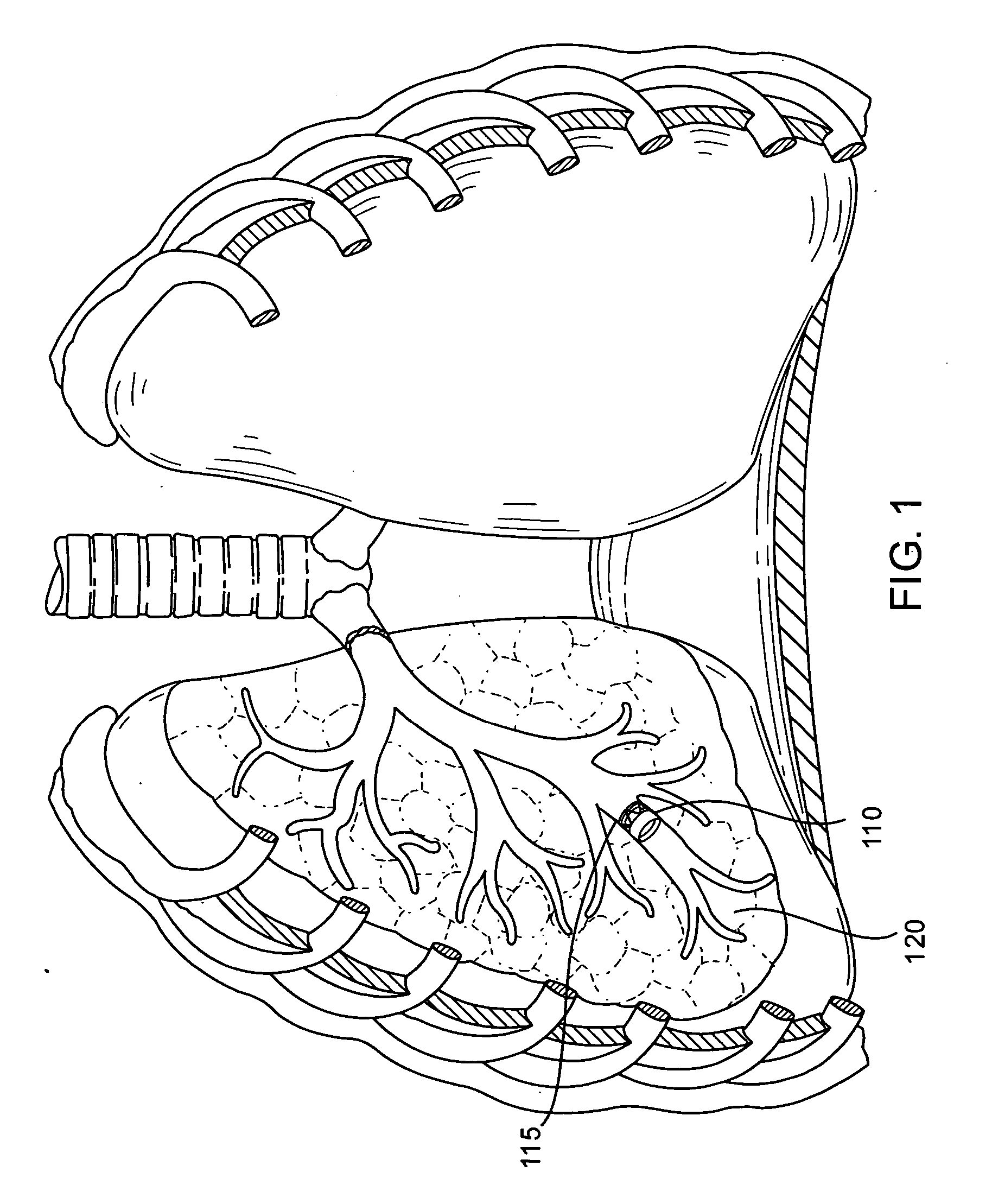 Implanted bronchial isolation devices and methods