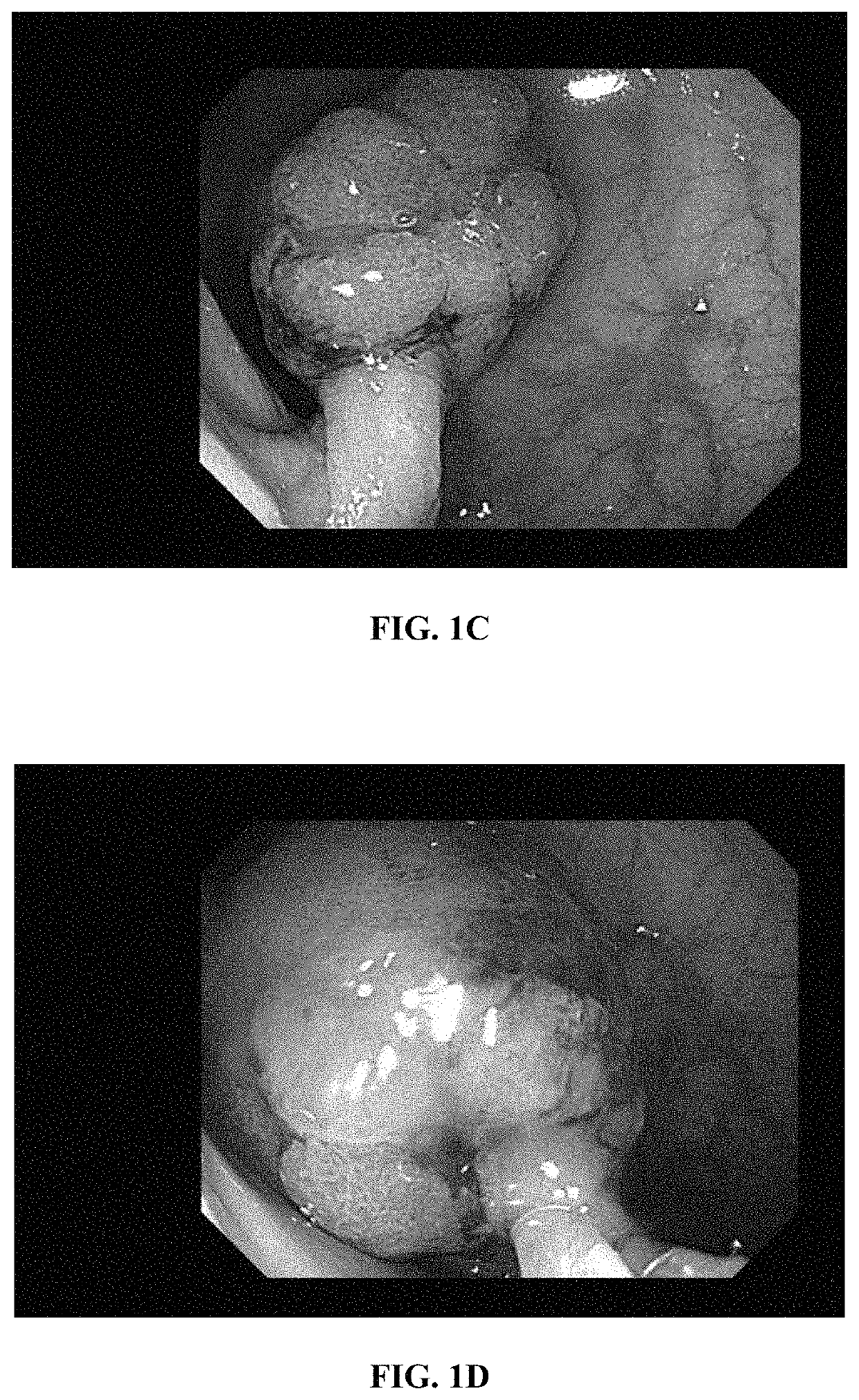 Snare for removing tumor