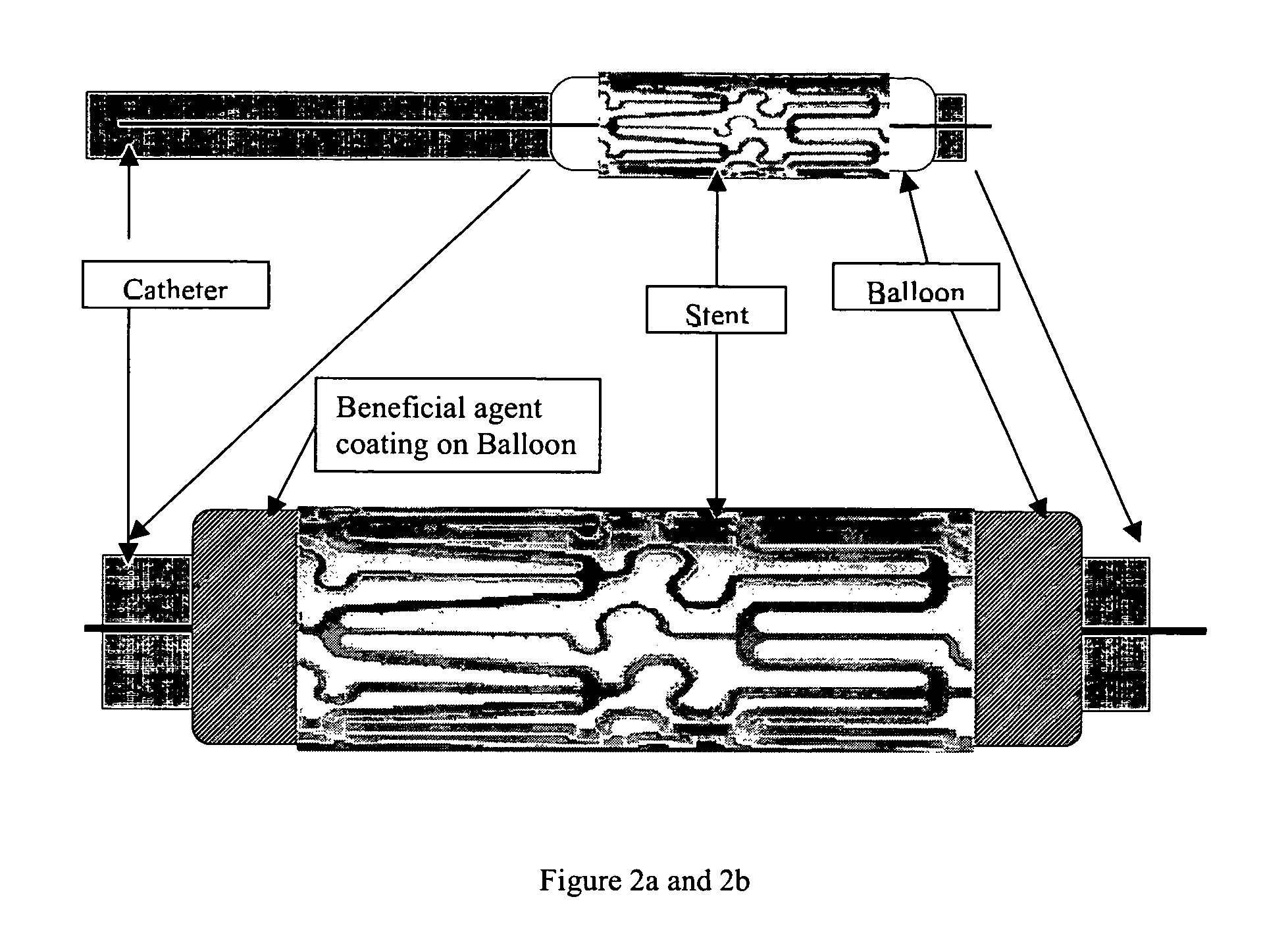 Multiple drug delivery from a balloon and a prosthesis