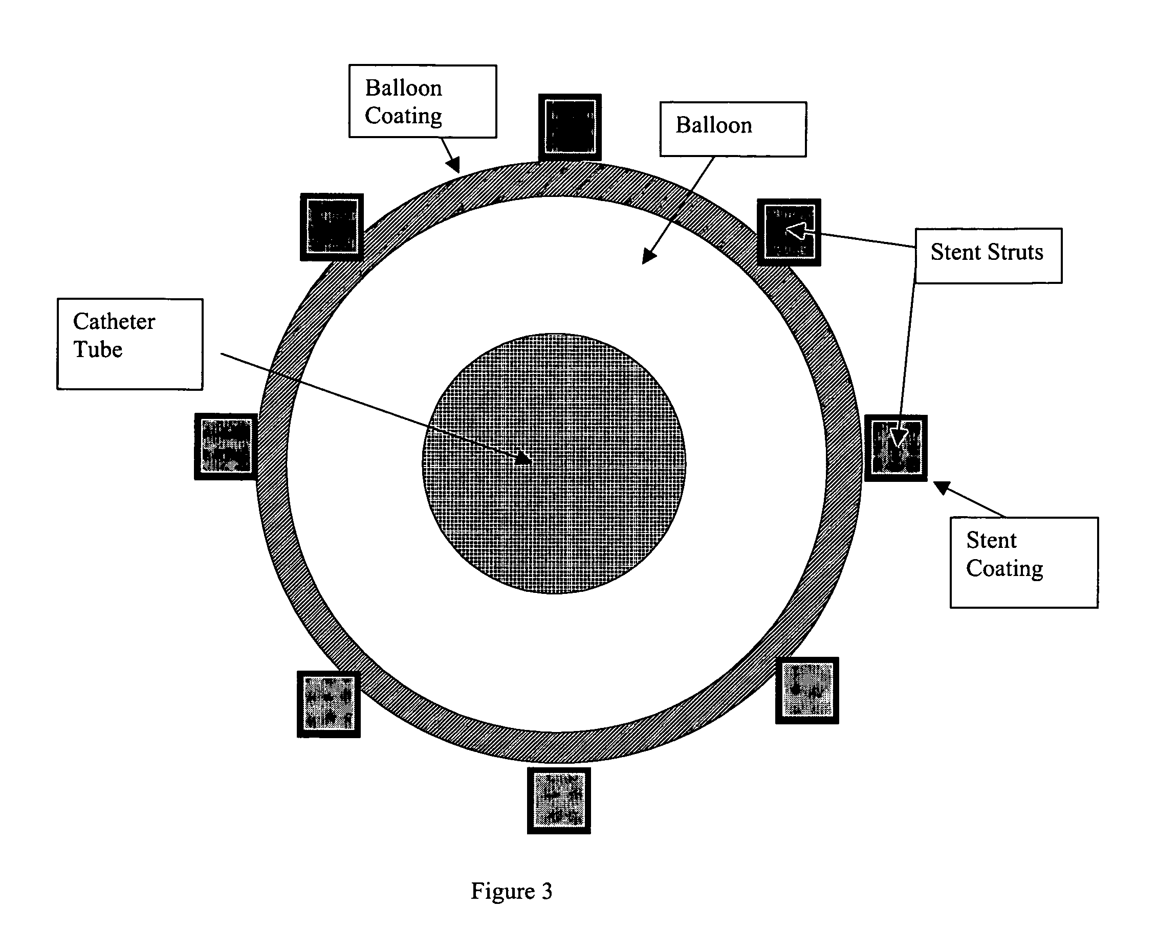 Multiple drug delivery from a balloon and a prosthesis