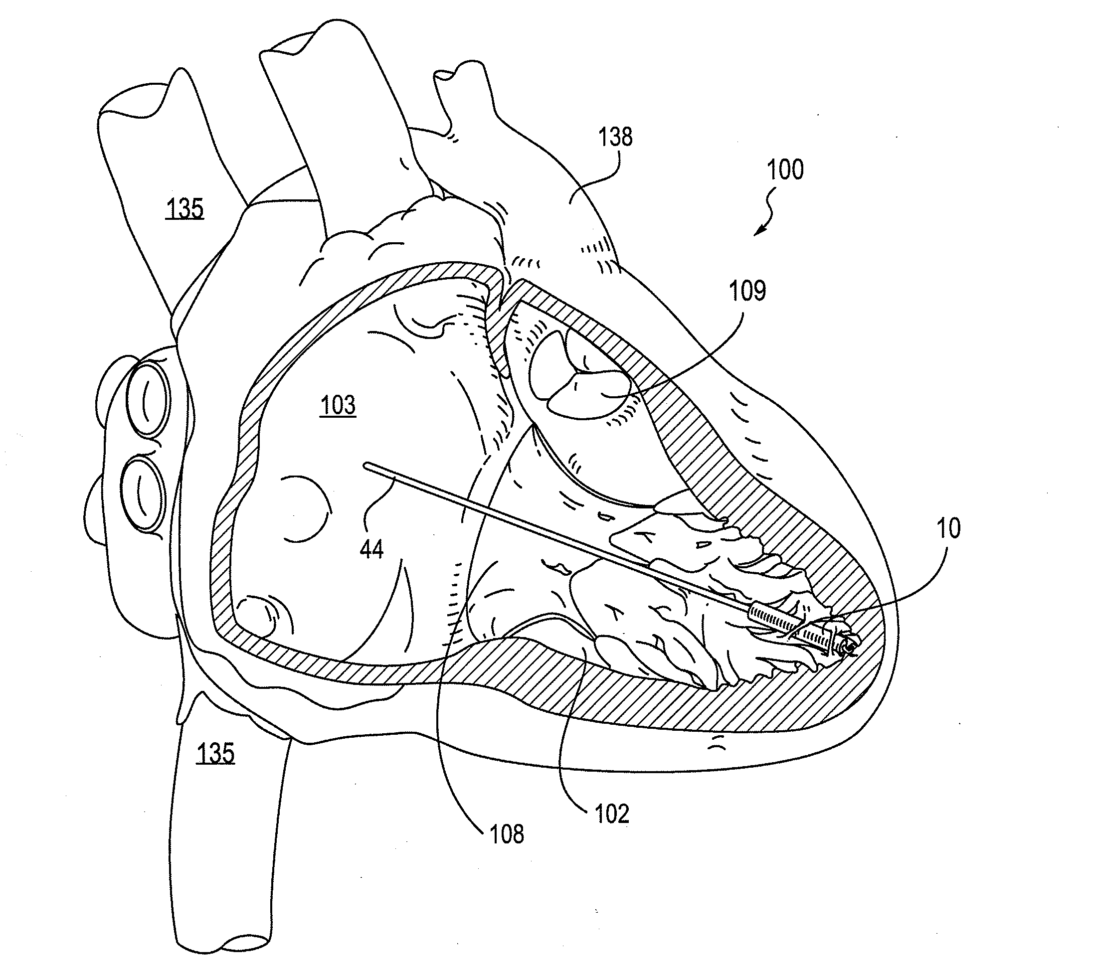 Leadless Cardiac Pacemaker with Secondary Fixation Capability