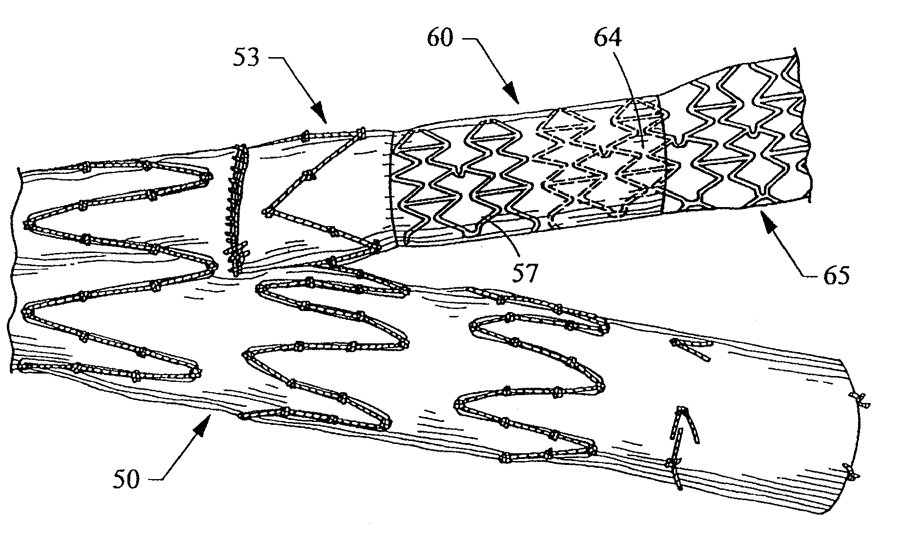 Socket For Fenestrated Tubular Prosthesis