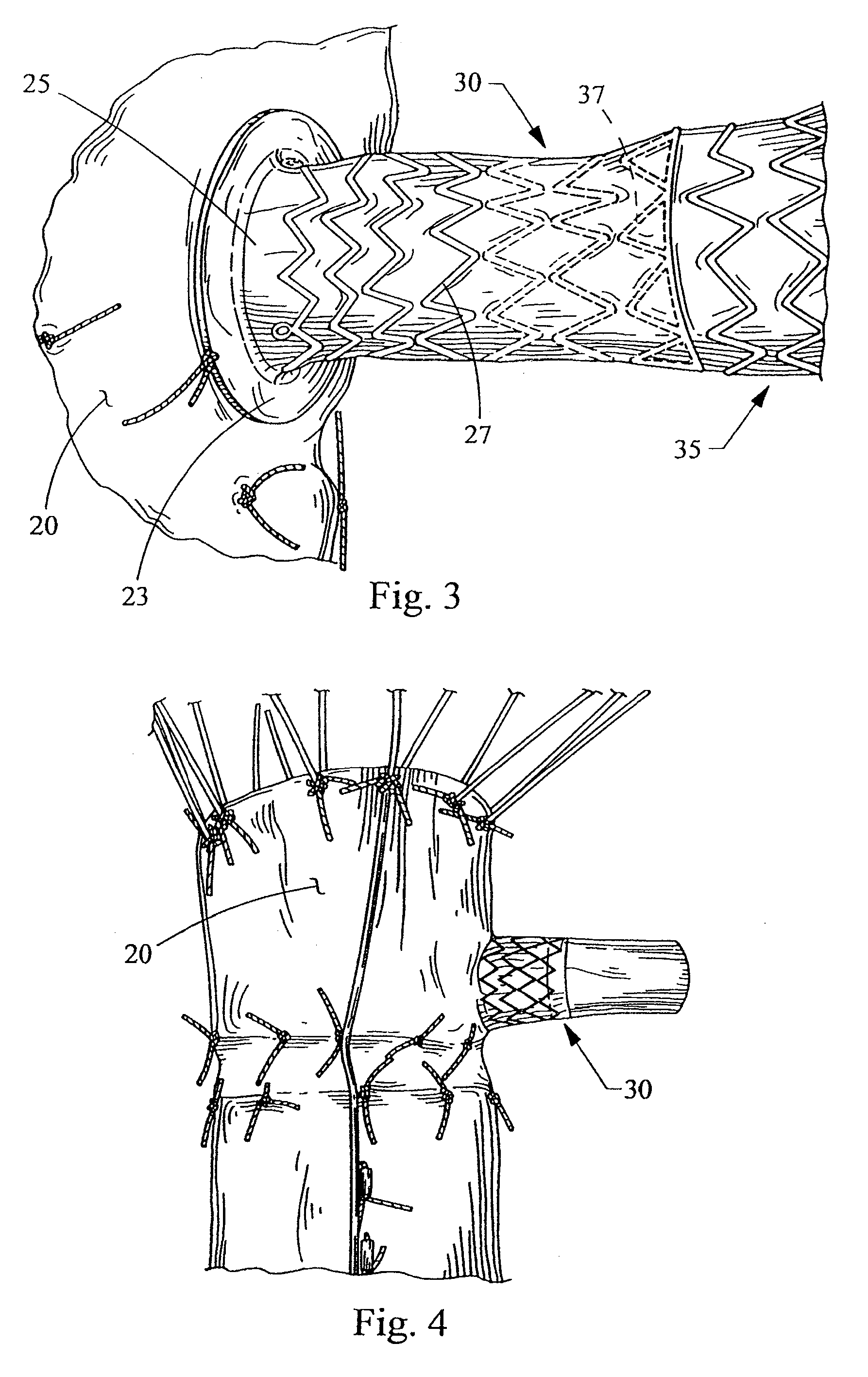 Socket For Fenestrated Tubular Prosthesis