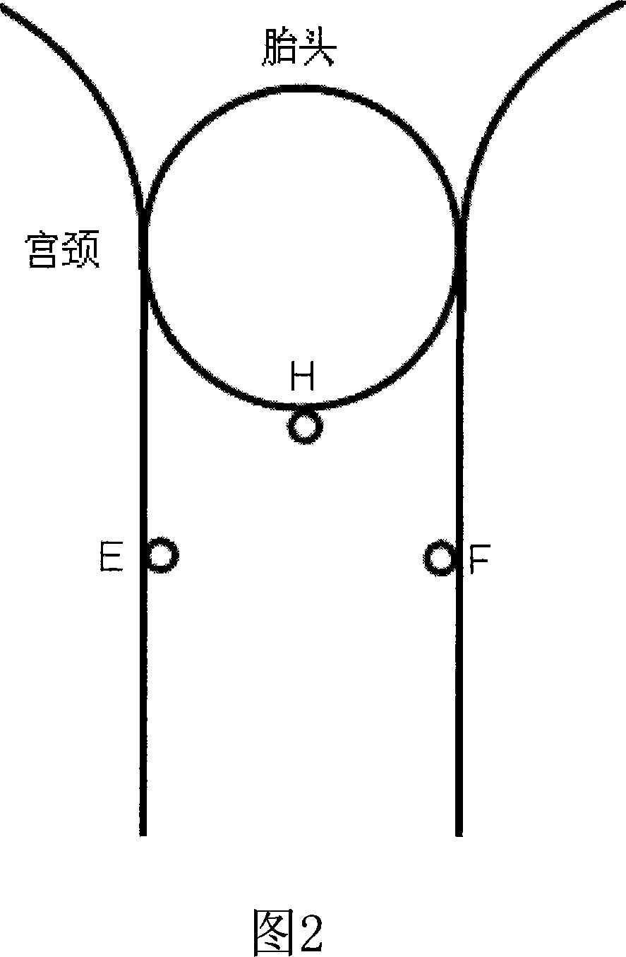 Device and method for supervising birth process