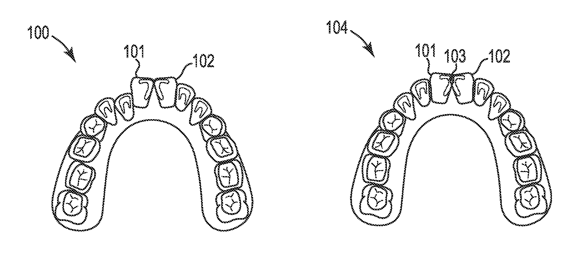 Interproximal reduction planning