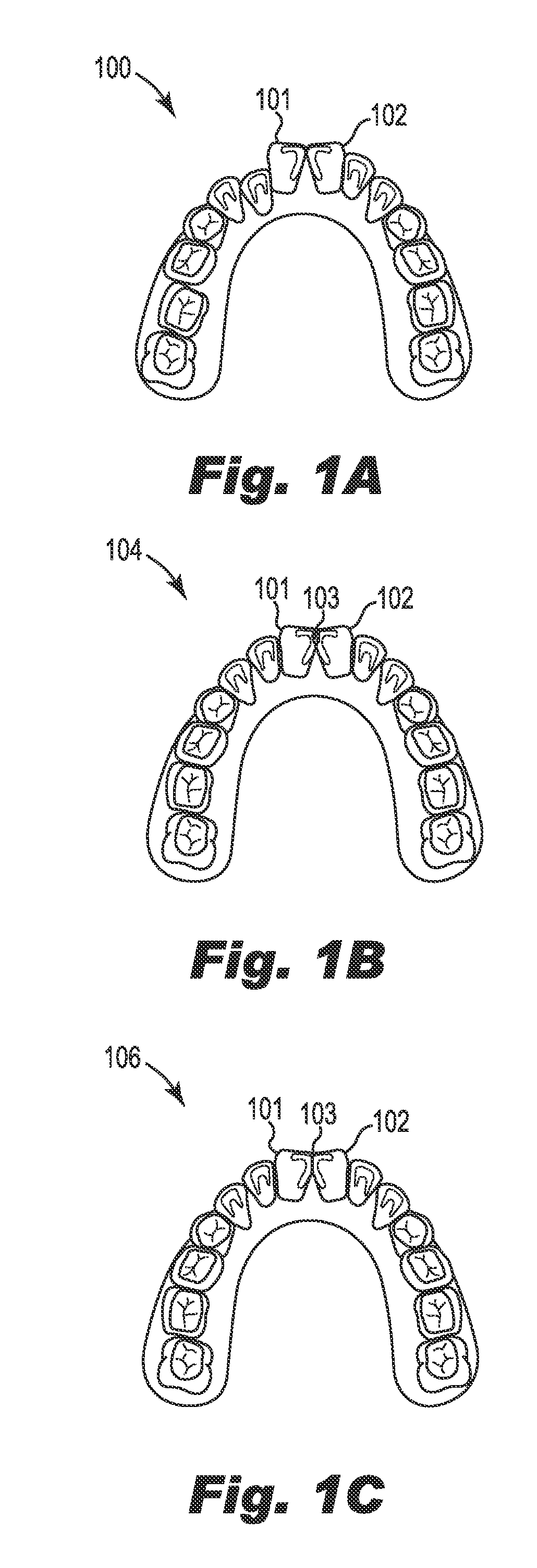 Interproximal reduction planning