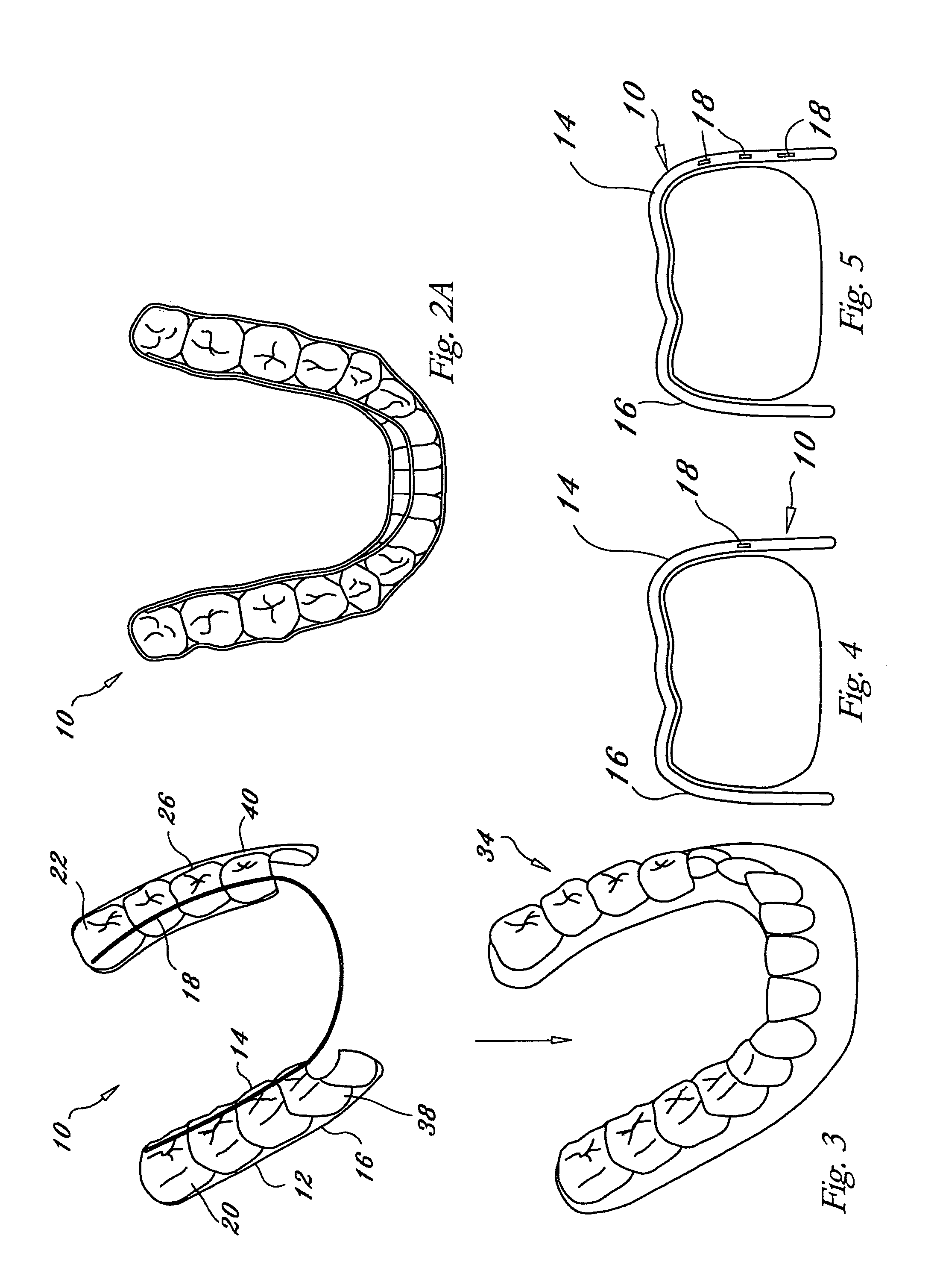 Orthodontic appliance with embedded wire for moving teeth and method