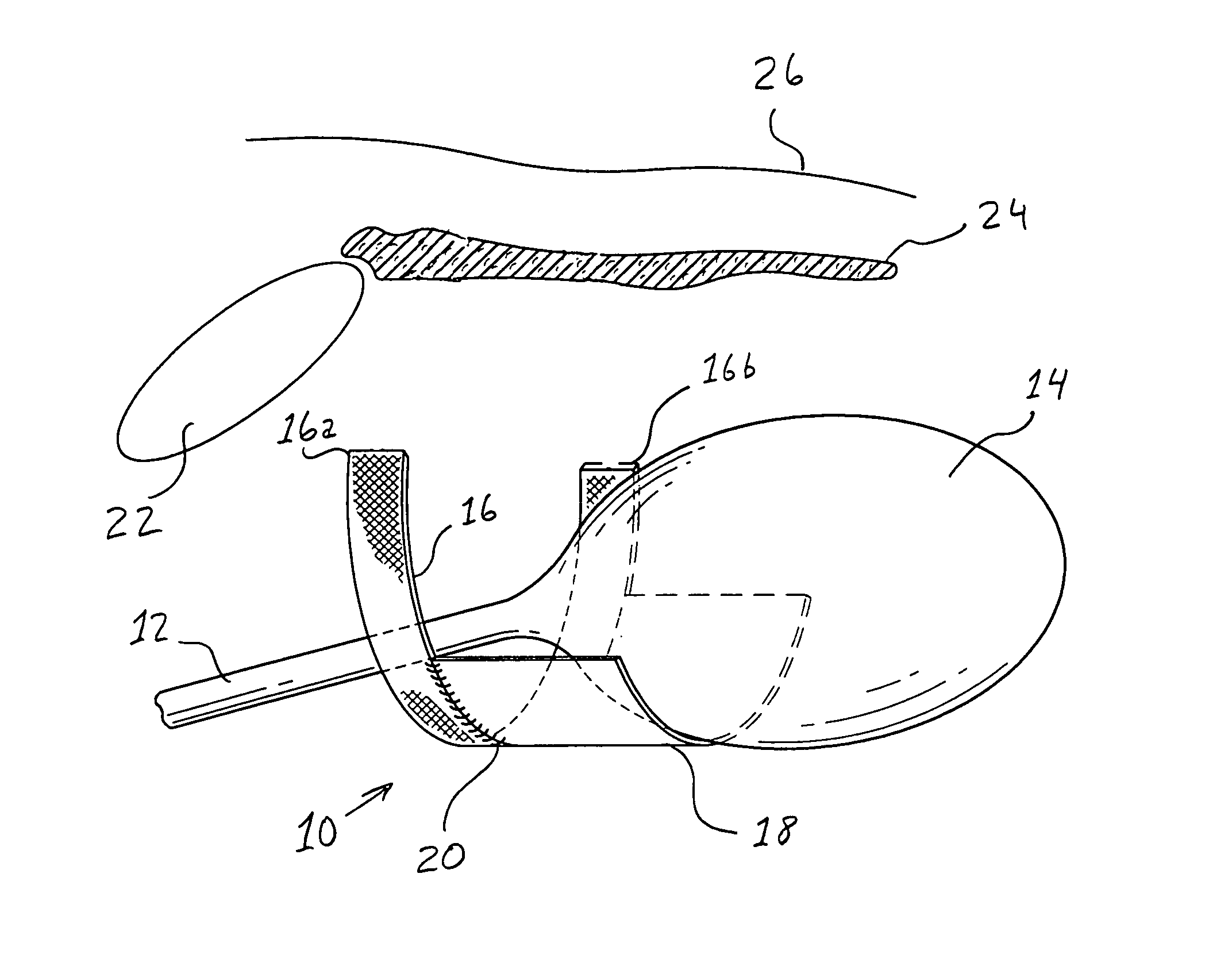 Implantable sling having bladder support