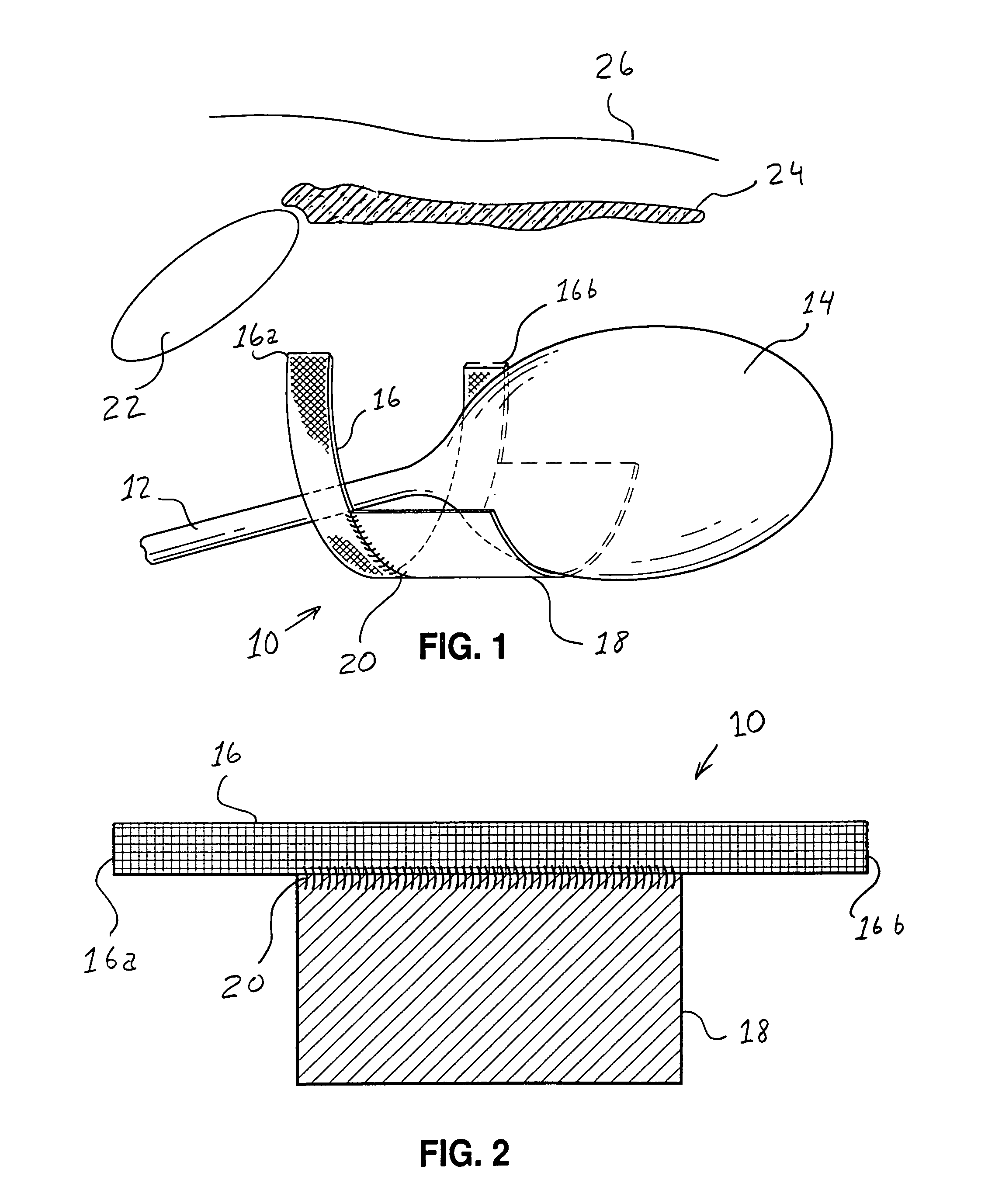 Implantable sling having bladder support