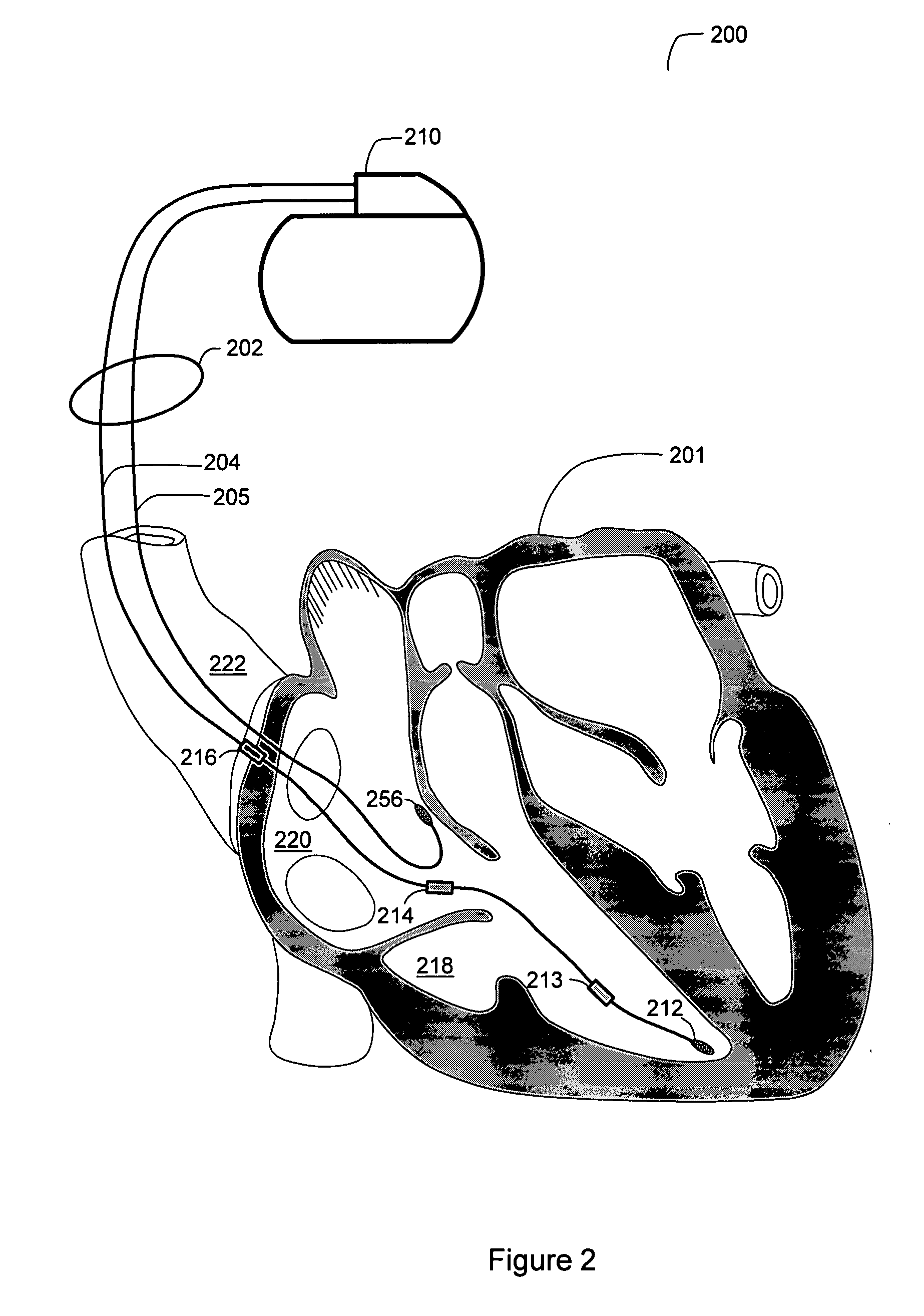 Detection of disordered breathing