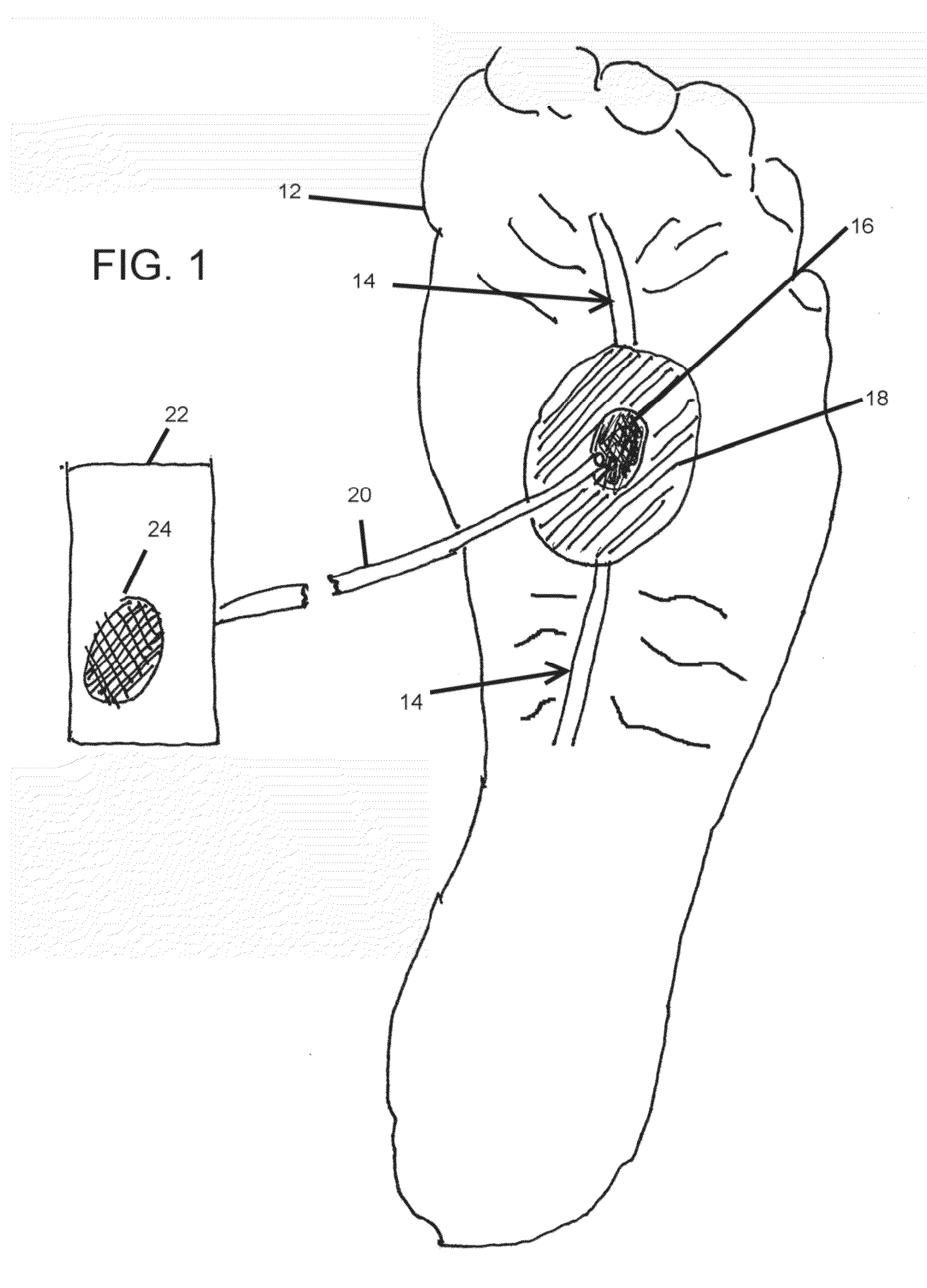 Non-invasive continuous doppler monitoring device for arterial blood flow to distal body parts