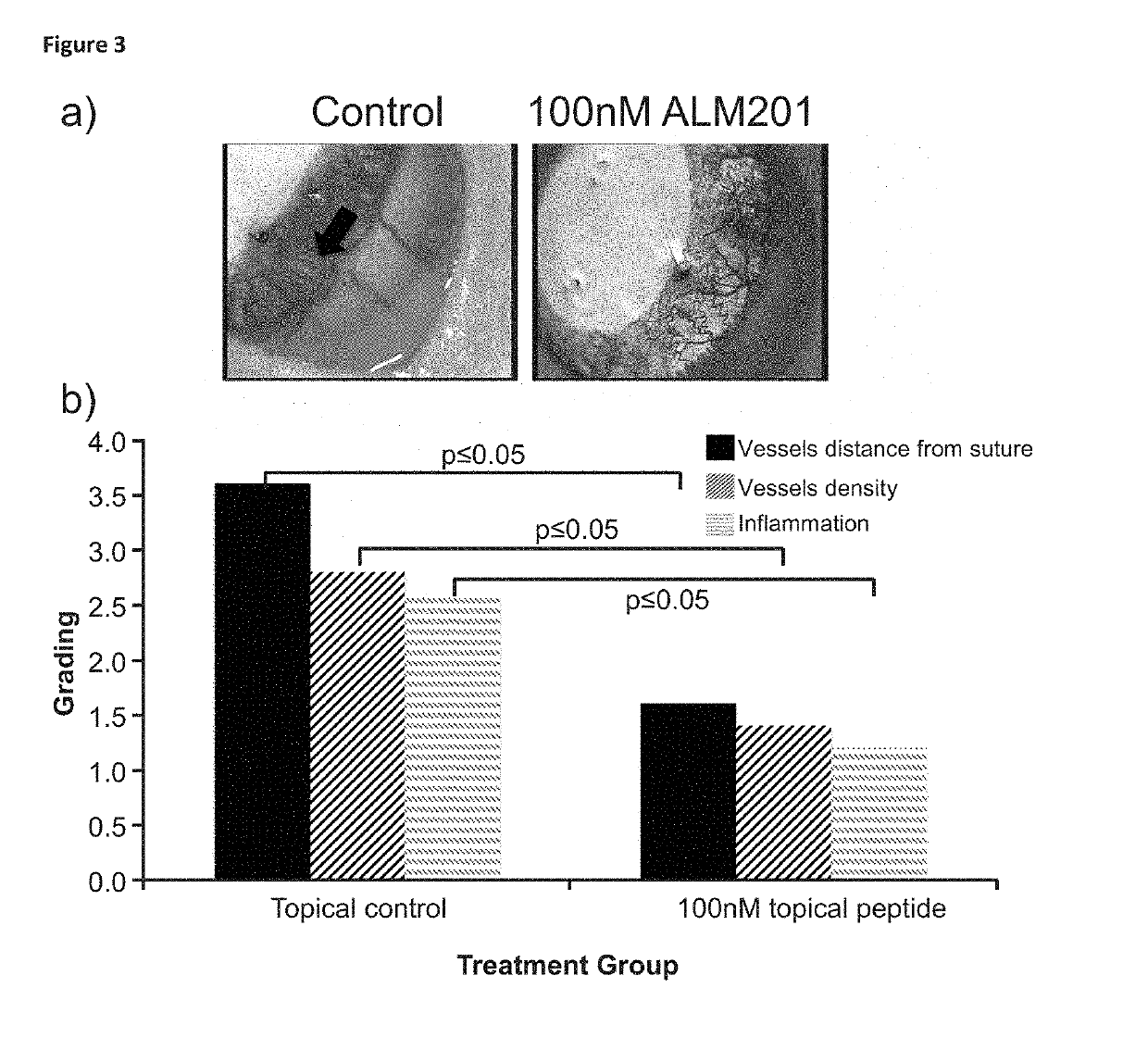 Treatment of ocular disease