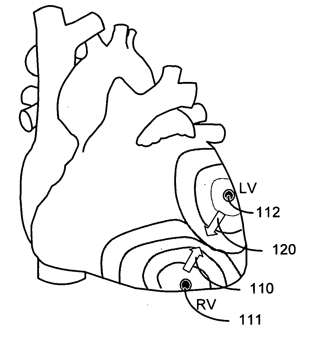 Capture detection based on propagated depolarization from a remote pacing site