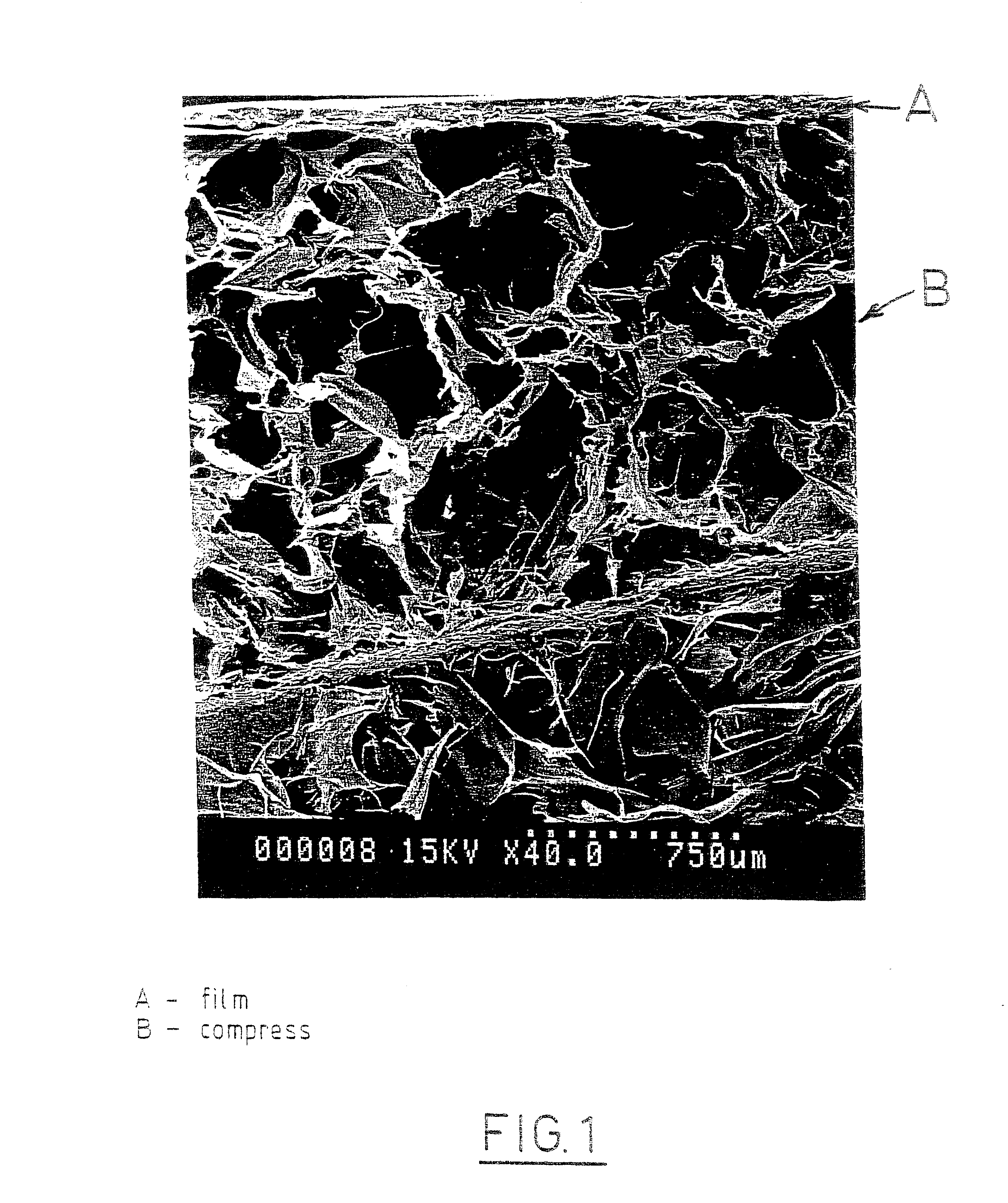 Method for preparing two-layer bicomposite collagen material for preventing post-operative adhesions