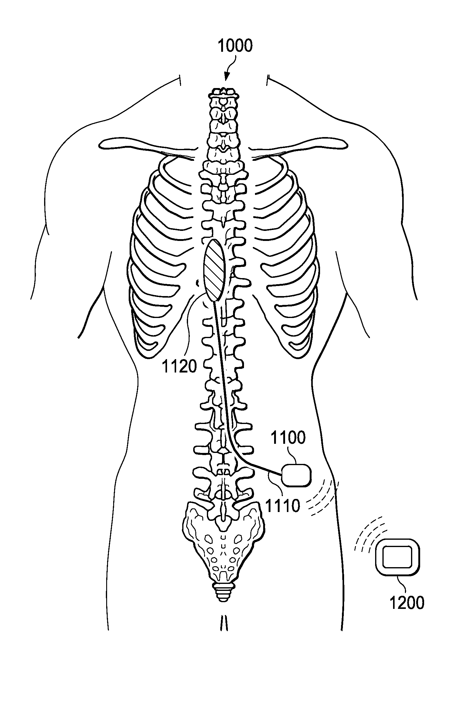 Method and System of Quick Neurostimulation Electrode Configuration and Positioning