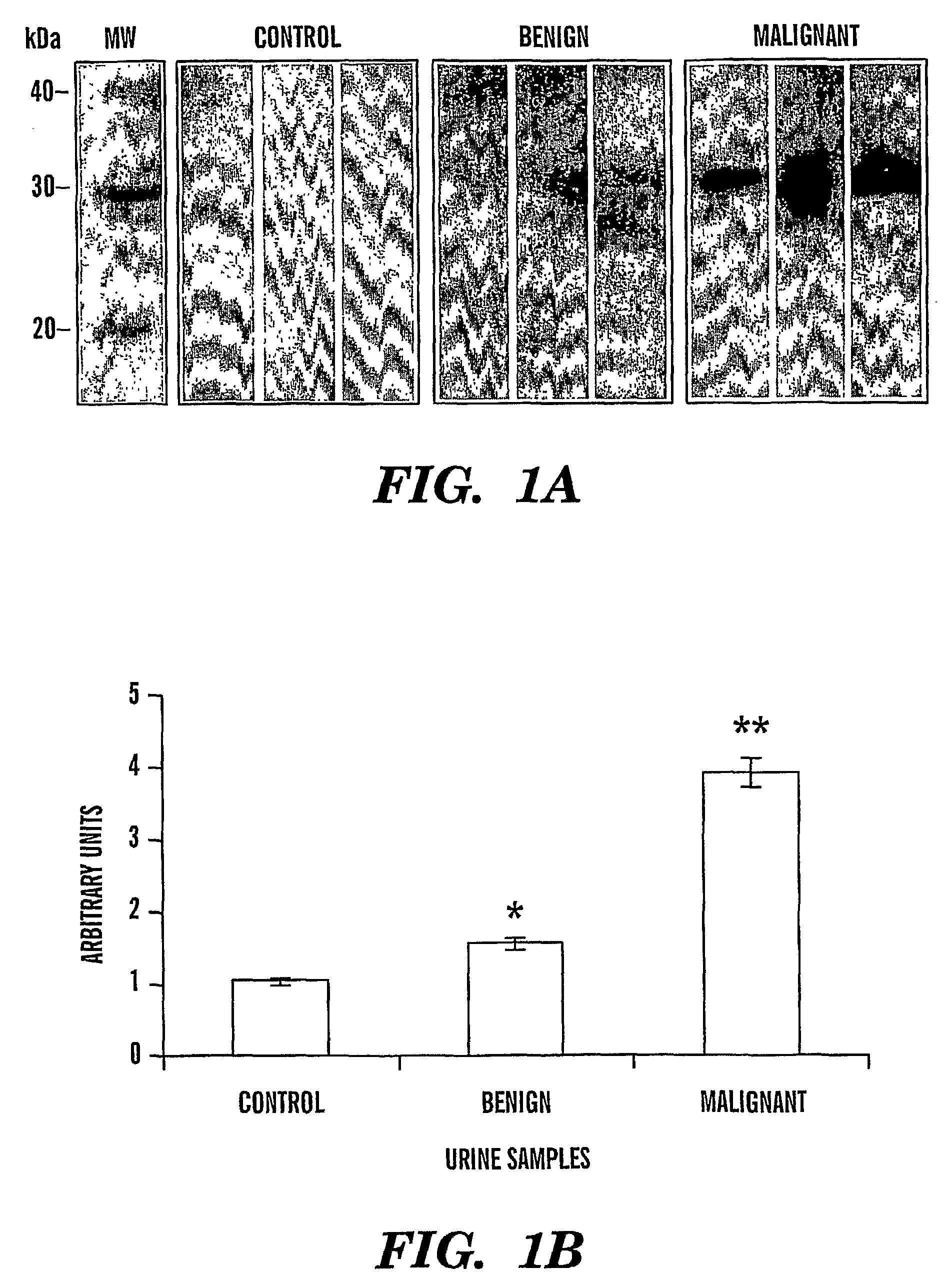 Cyr61 as a biomarker for diagnosis and prognosis of cancers of epithelial origin