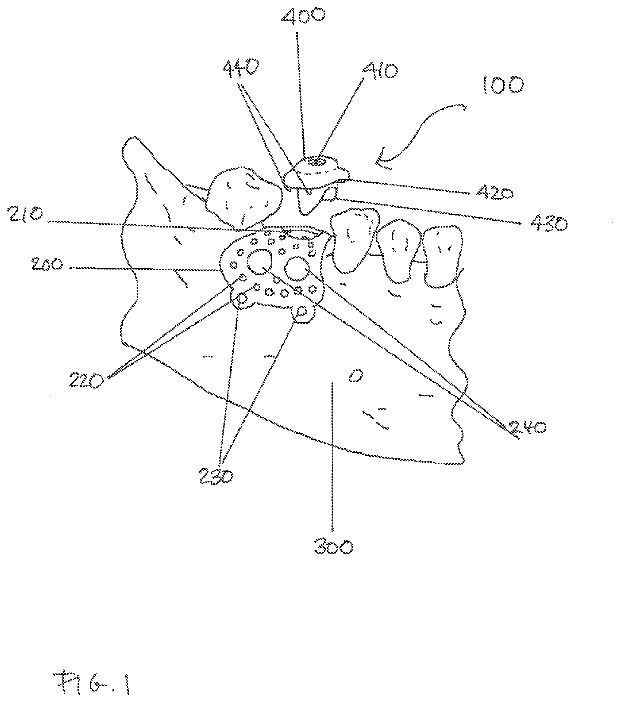 Dental Ridge Augmentation Matrix with Integrated Dental Implant Surgical Drill Guide System