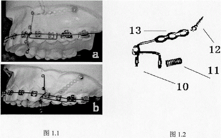 Sliding rod type tooth retrusion device