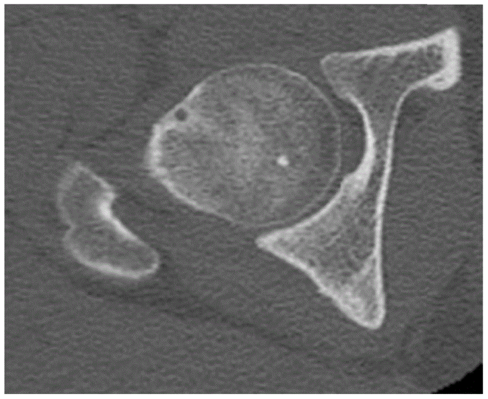 Acetabulum tissue model reconstruction method for serialization hip joint CT image