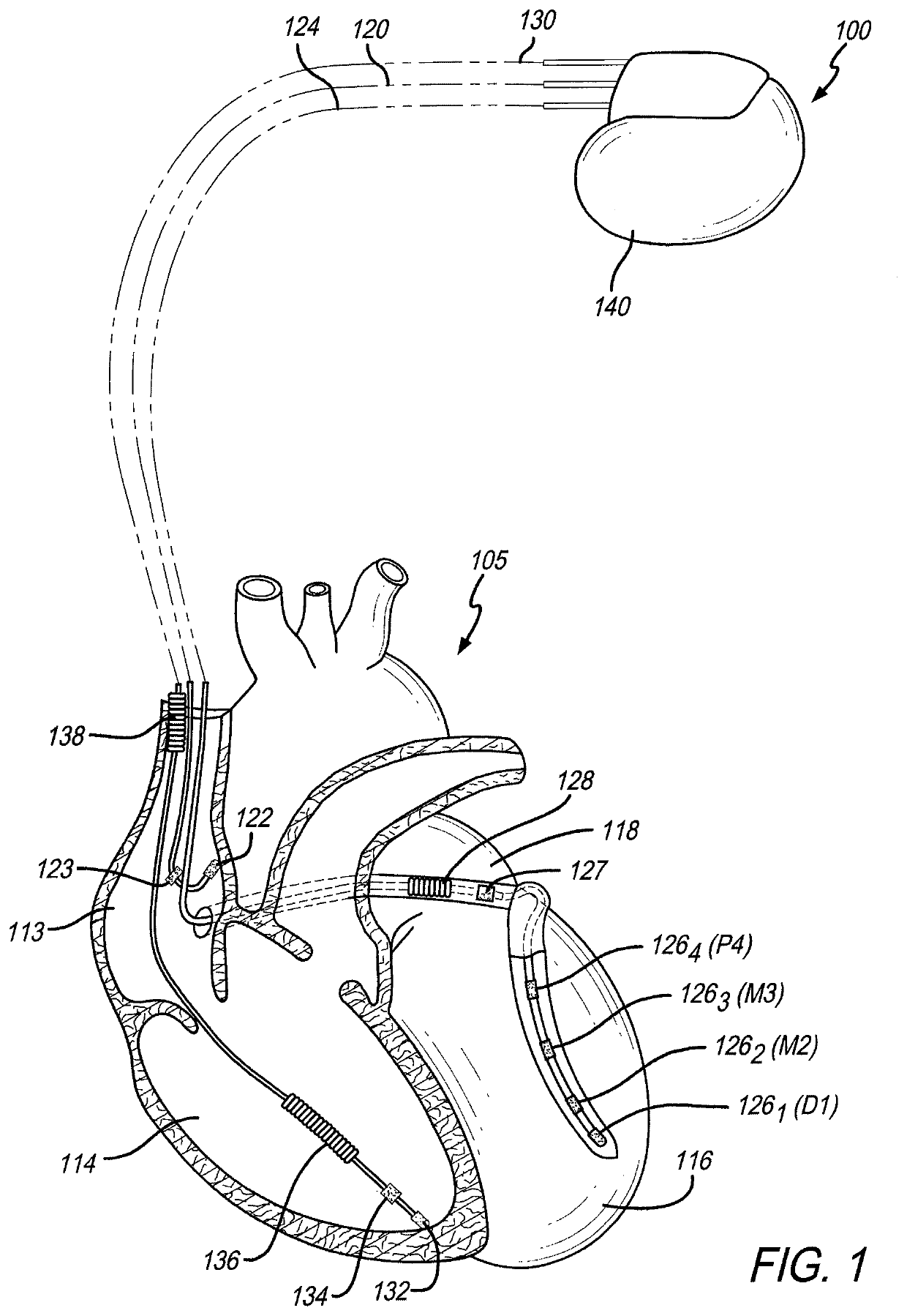 Method and system for adaptive bi-ventricular fusion pacing