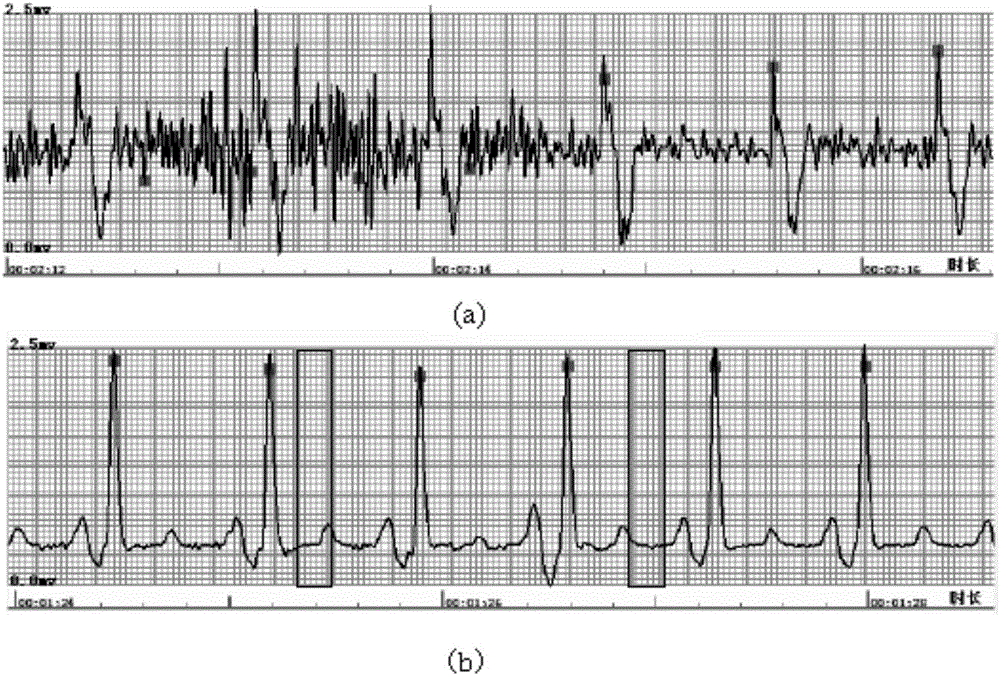 Electrocardiosignal preanalysis method