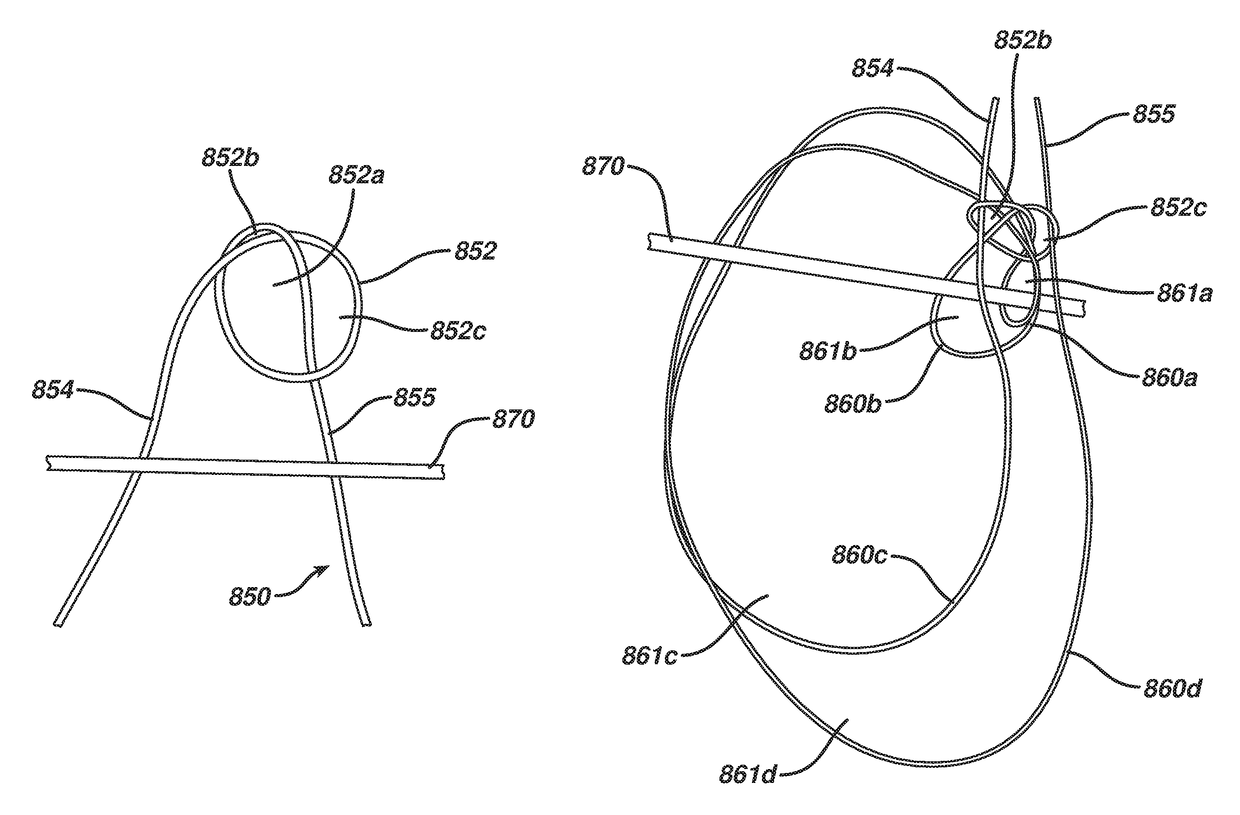 Implant having adjustable filament coils