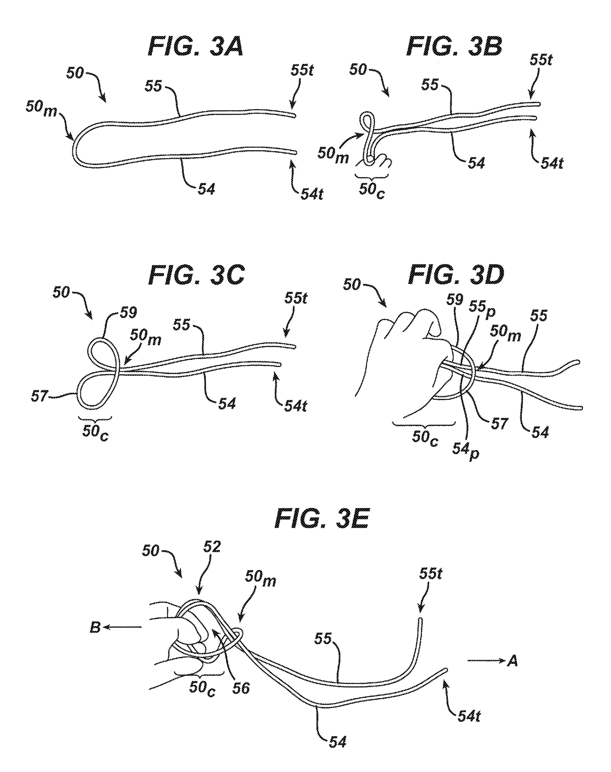 Implant having adjustable filament coils