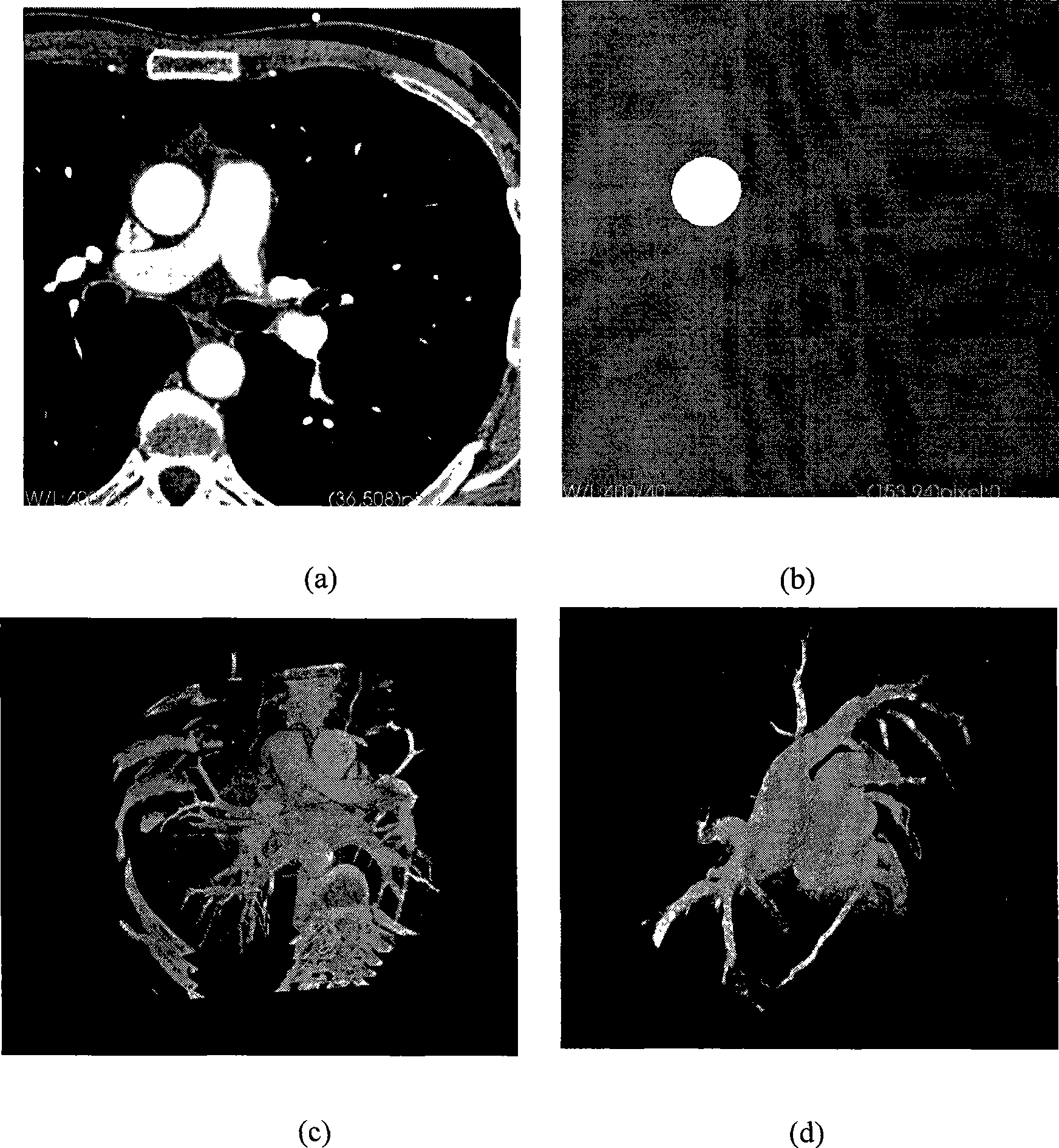 Simulated operation planning method based on medical image