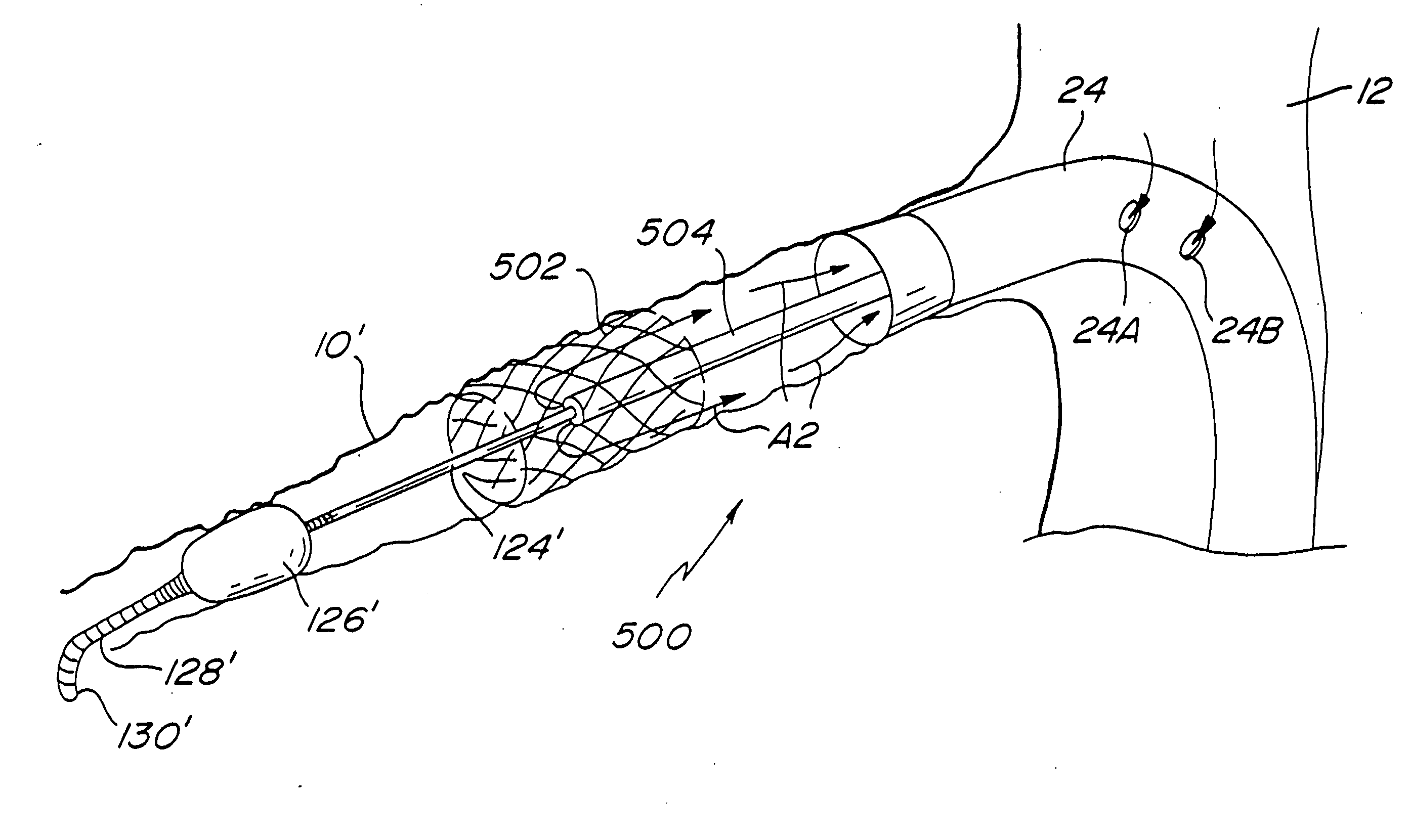 Method for opening a lumen in an occluded blood vessel