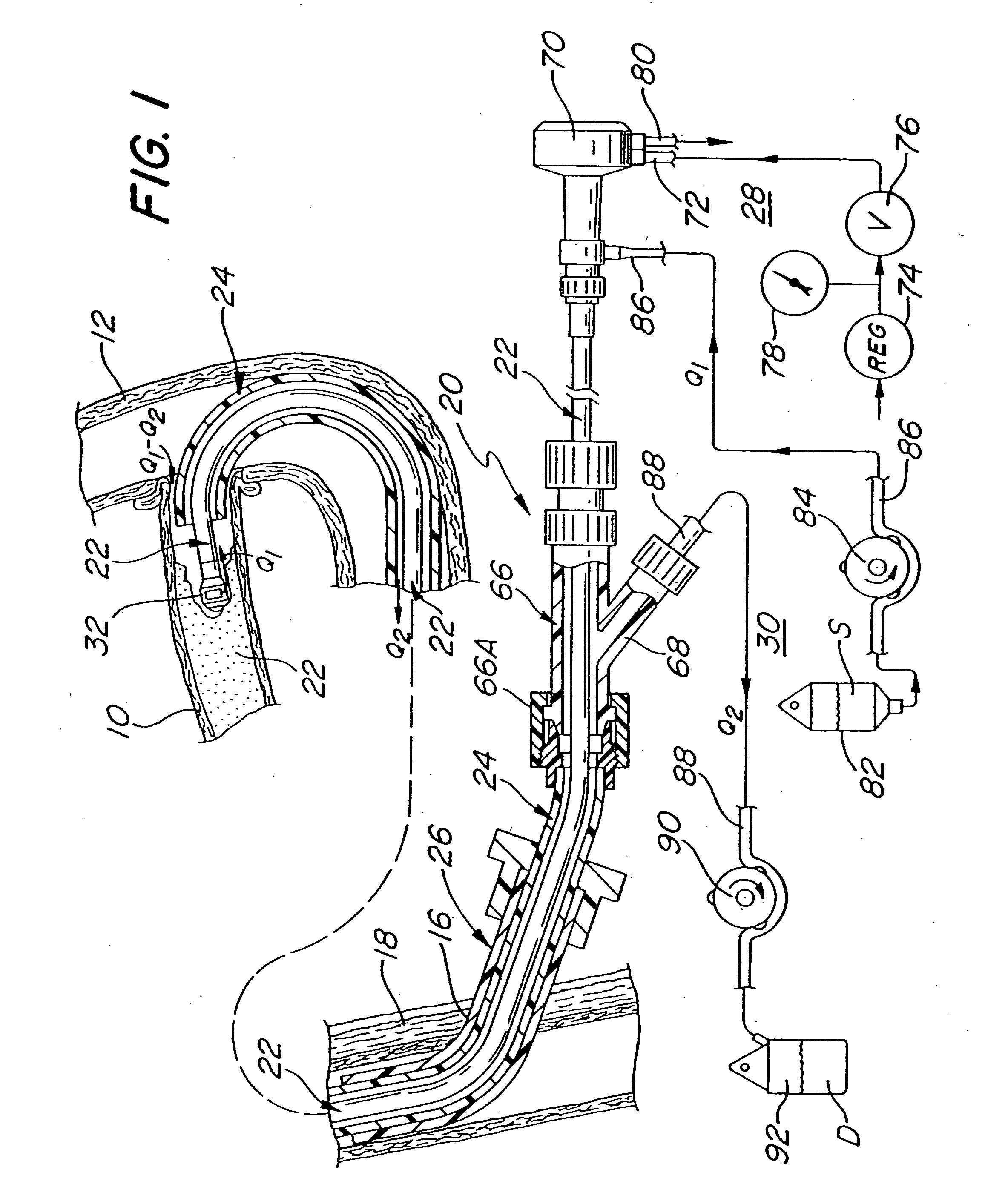 Method for opening a lumen in an occluded blood vessel