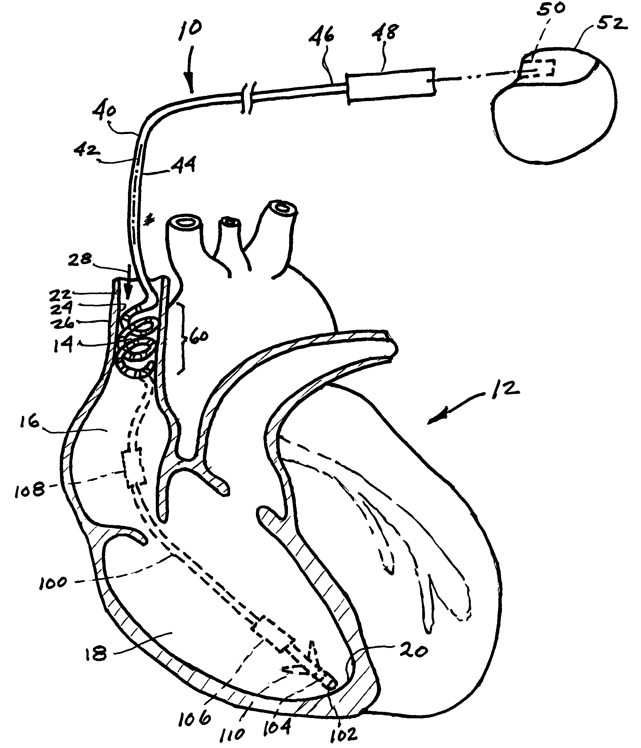 Endovascular lead for chronic nerve stimulation