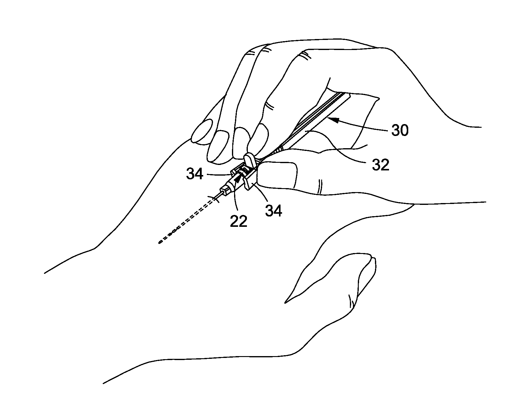 Over the needle catheter with curvilinear slit