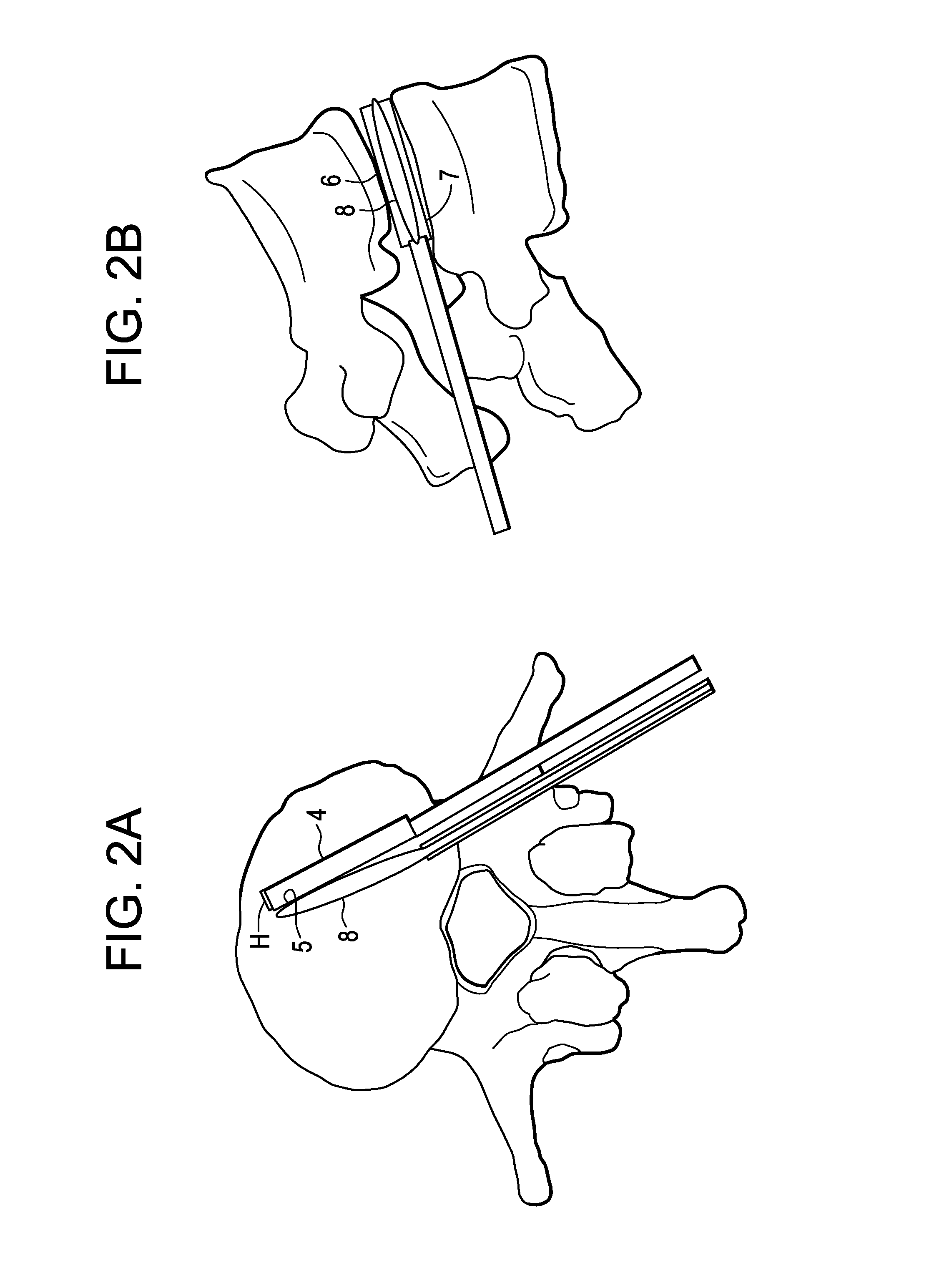 Balloon With Shape Control For Spinal Procedures