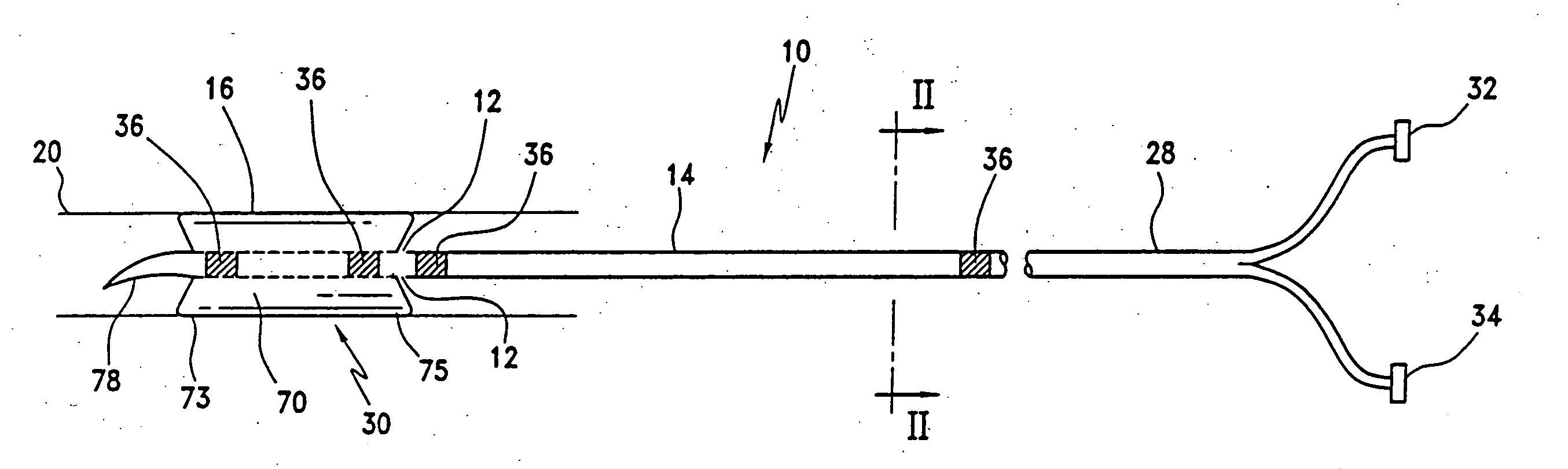 Method and apparatus for treatment of thrombosed hemodialysis access grafts and arterio venous fistulas