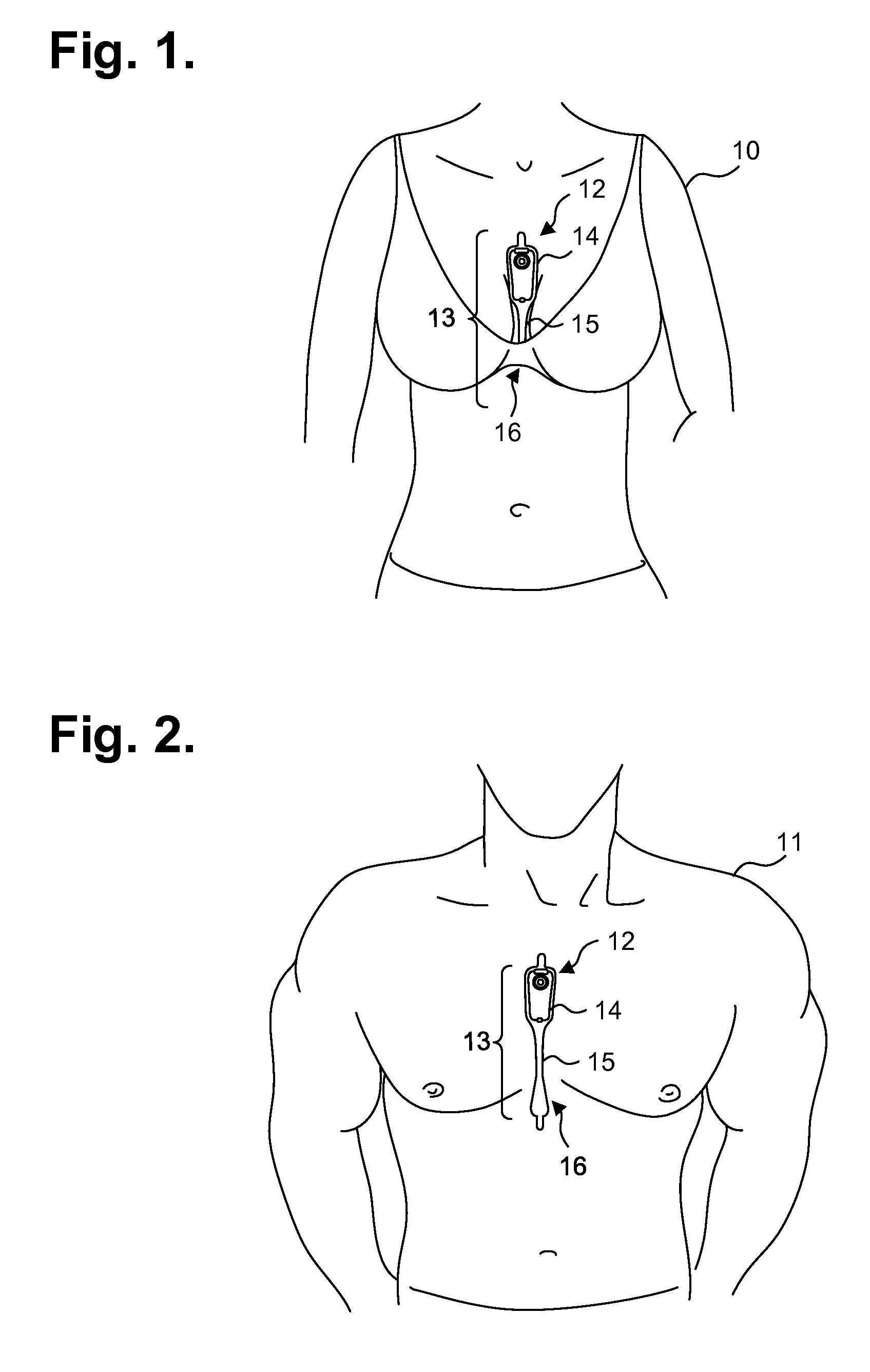 Ambulatory Electrocardiography Monitor Recorder Optimized For Capturing Low Amplitude Cardiac Action Potential Propagation