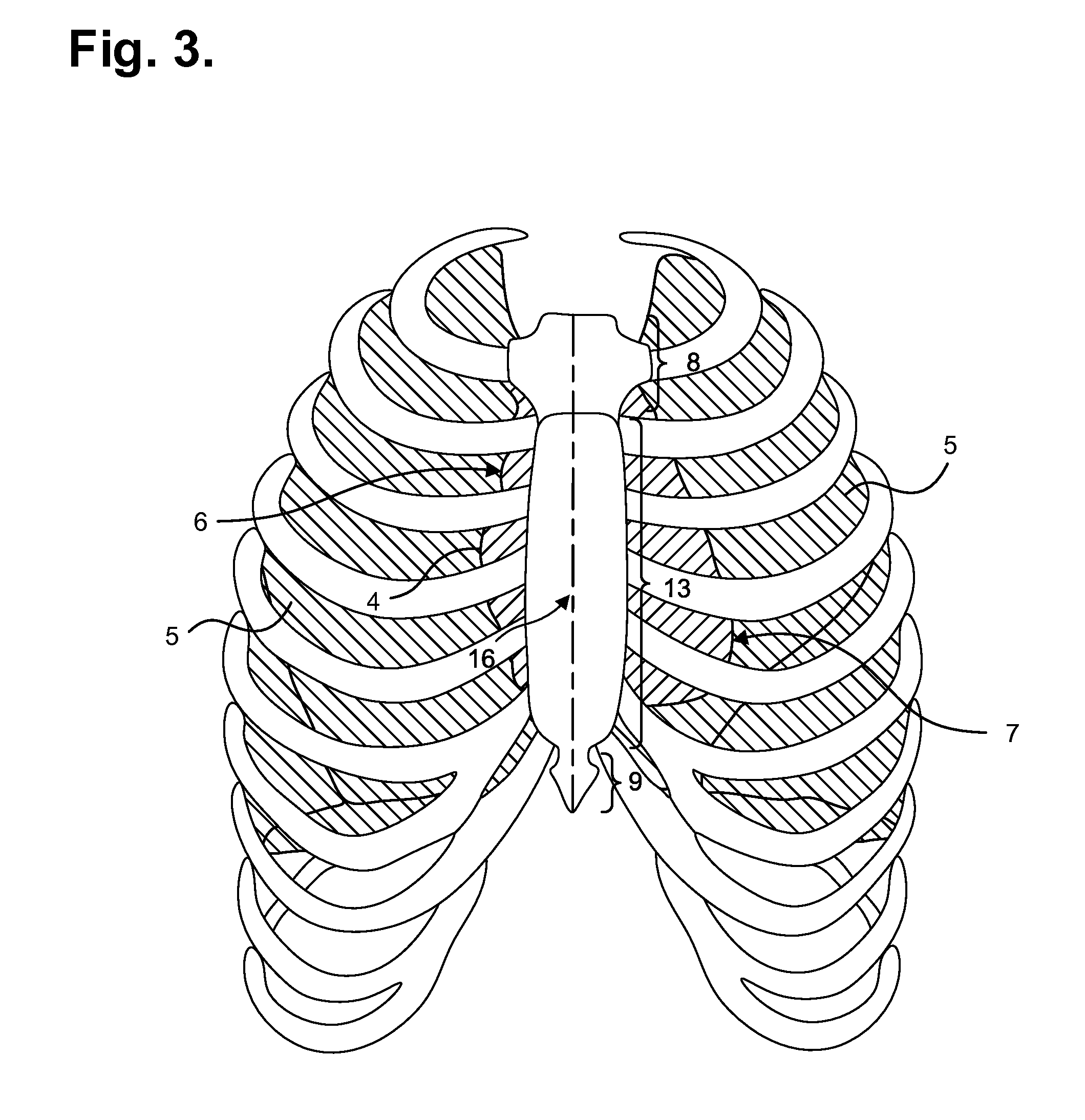 Ambulatory Electrocardiography Monitor Recorder Optimized For Capturing Low Amplitude Cardiac Action Potential Propagation