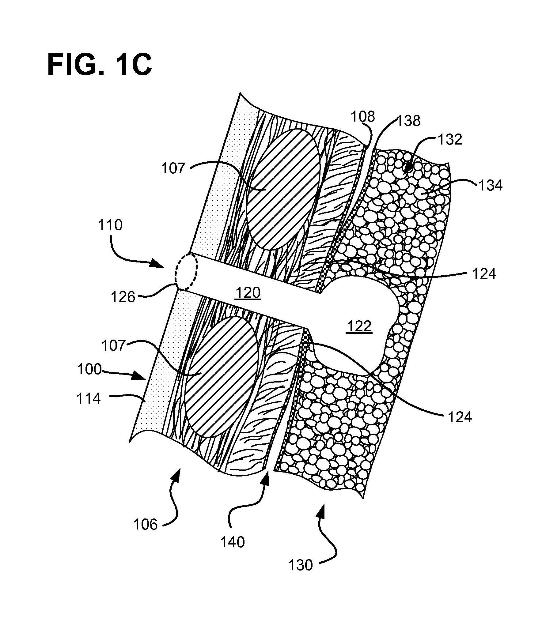 Pneumostoma management device and method for treatment of chronic obstructive pulmonary disease