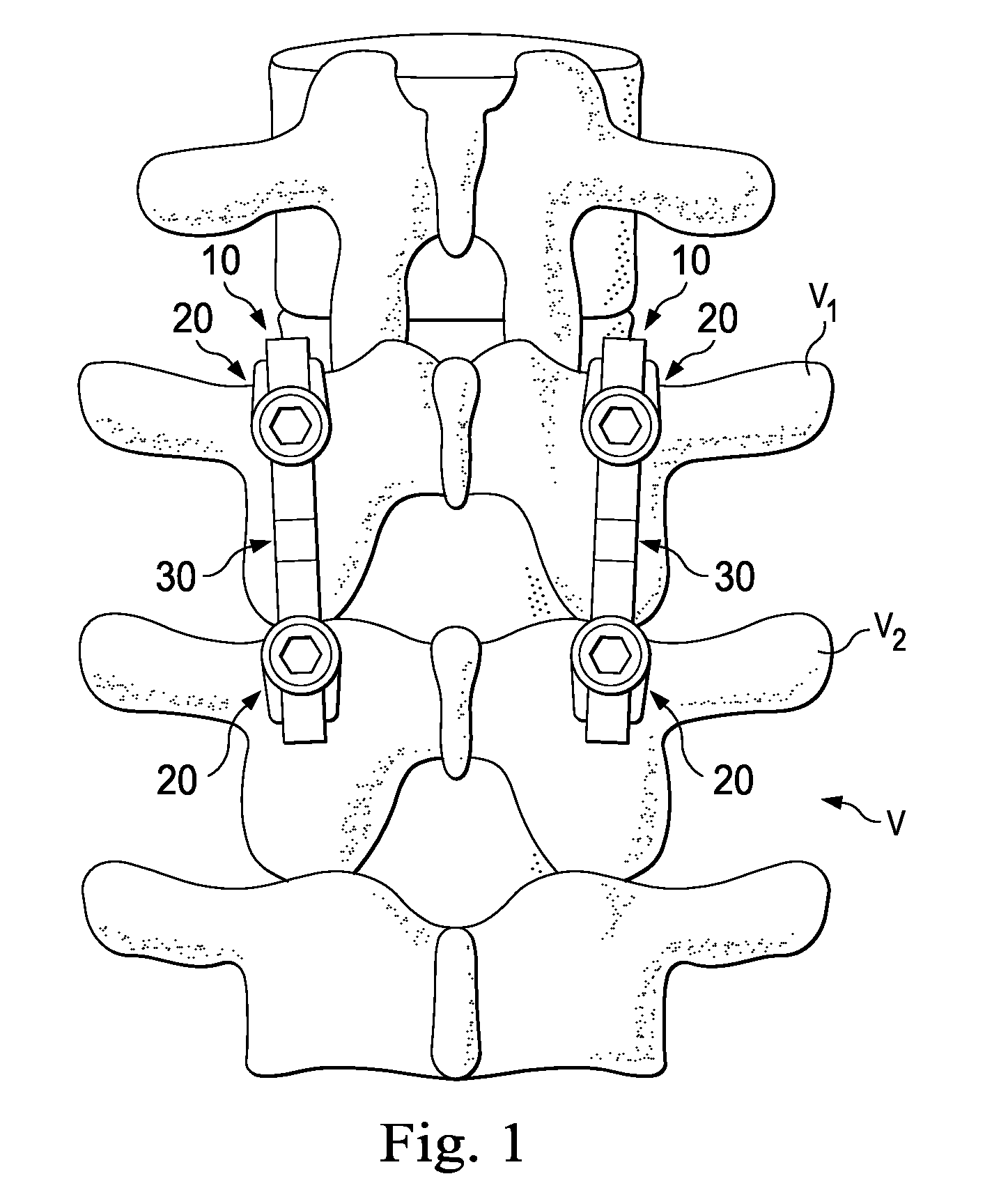 Spinal constructs with improved load-sharing