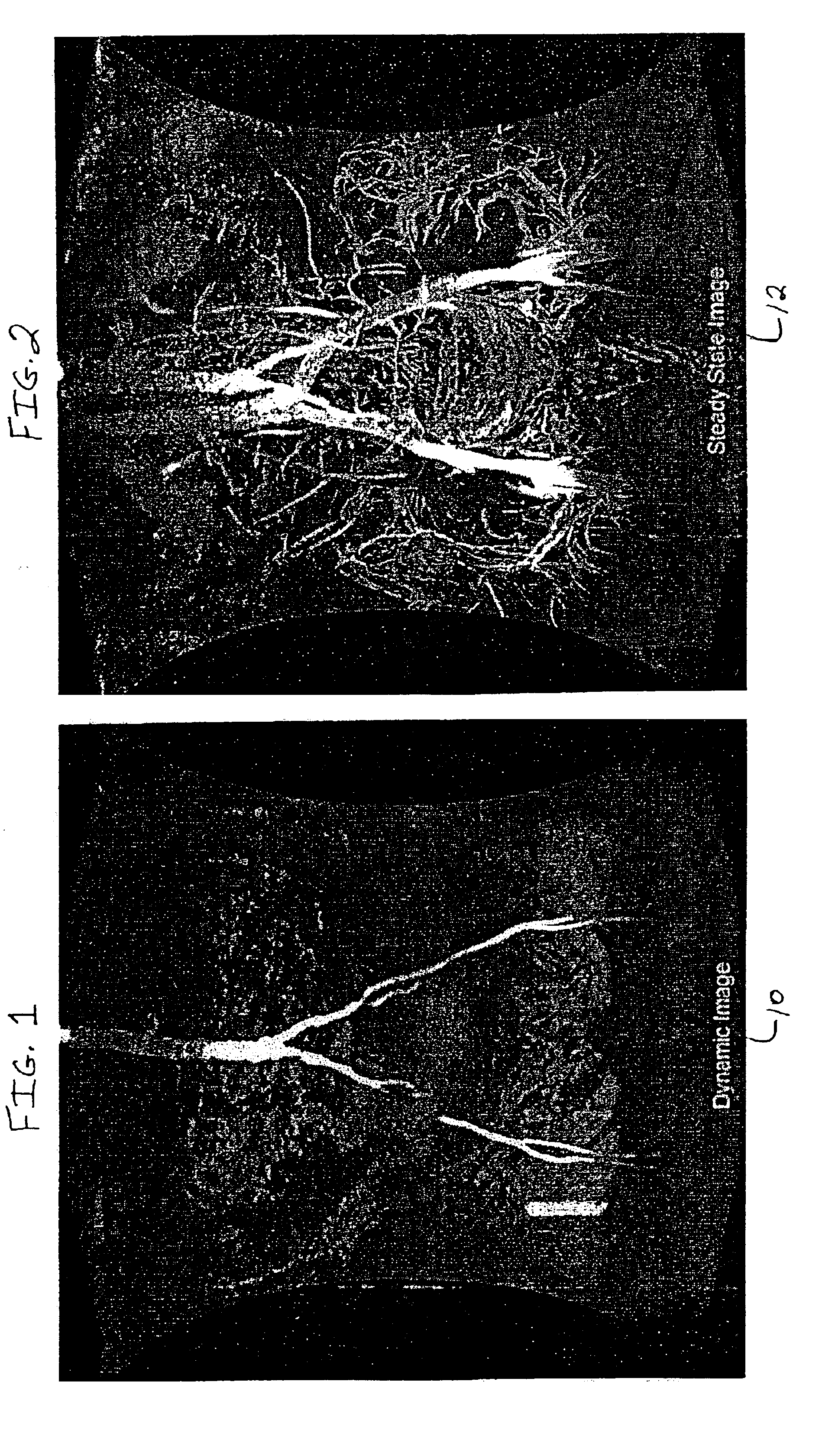 Magnetic resonance angiography data