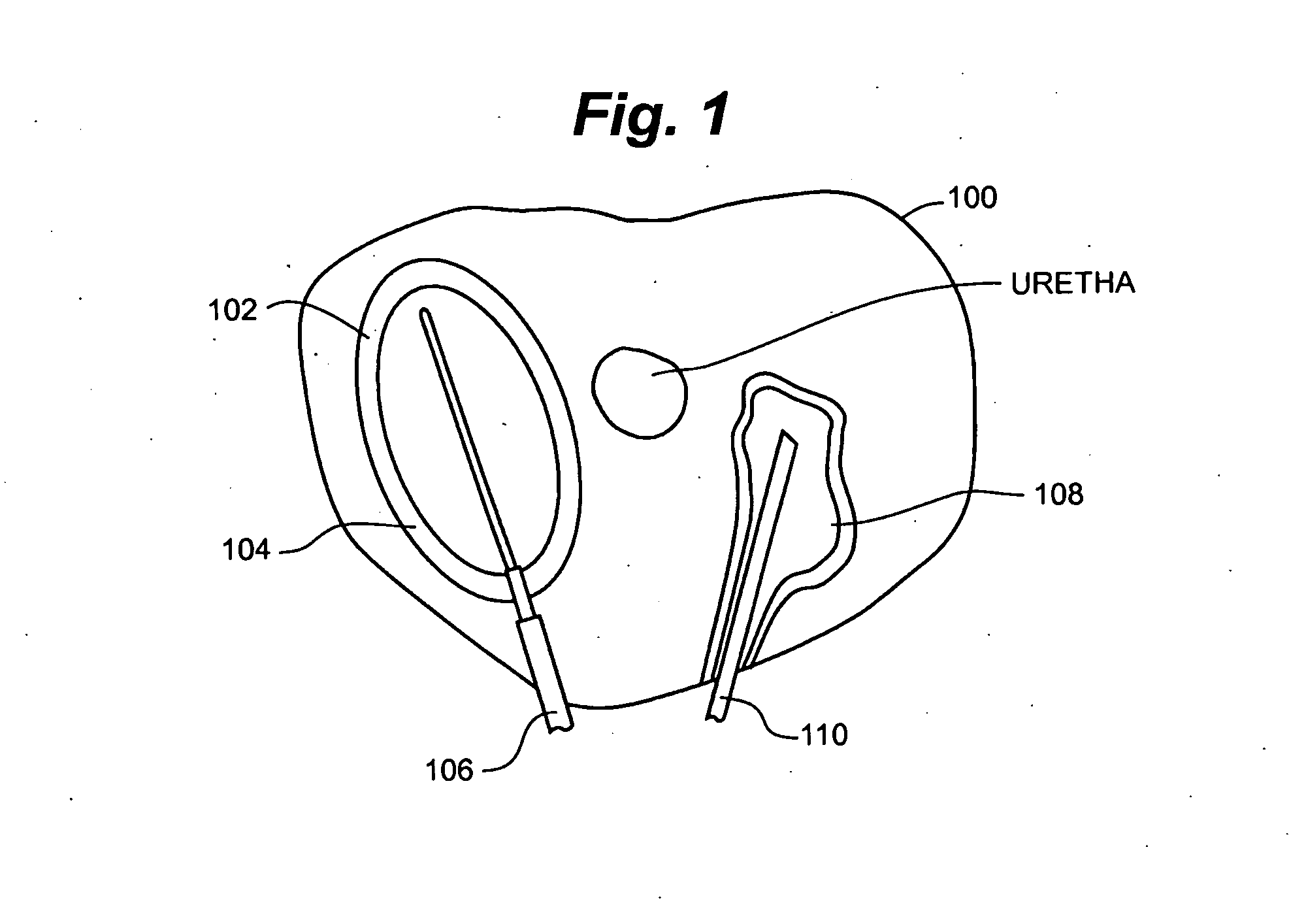 Tissue infusion system and method