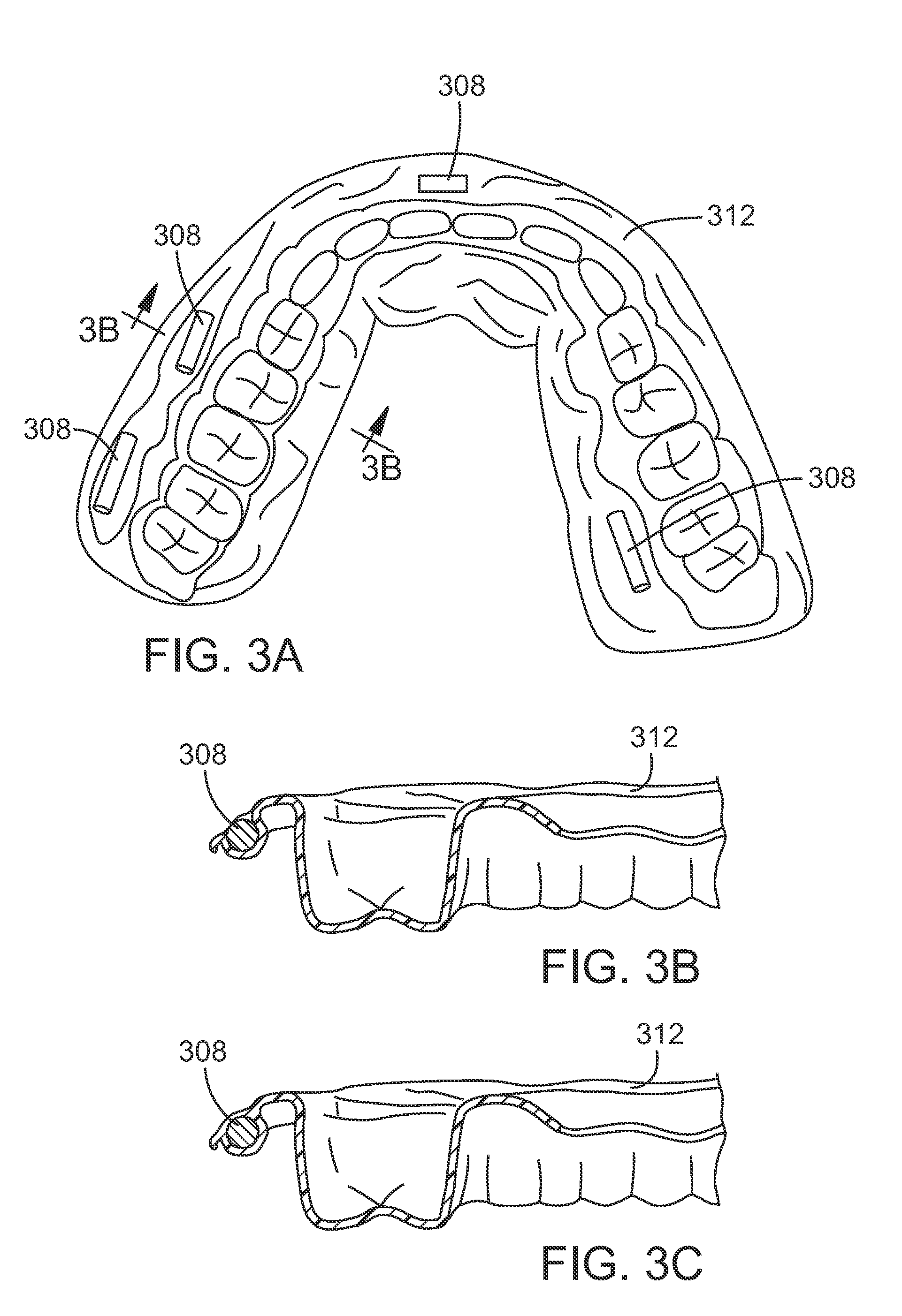 Head and neck radiation localization using oral appliance